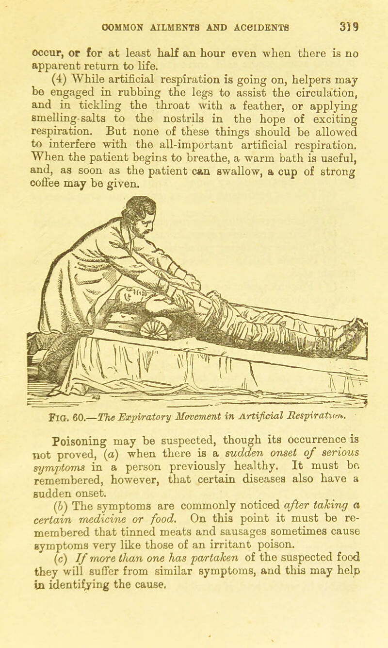 occur, or for at least half an hour even when there is no apparent return to life. (4) While artificial respiration is going on, helpers may be engaged in rubbing the legs to assist the circulation, and in tickling the throat with a feather, or applying smelling-salts to the nostrils in the hope of exciting respiration. But none of these things should be allowed to interfere with the all-important artificial respiration. When the patient begins to breathe, a warm bath is useful, and, as soon as the patient can swallow, a cup of strong coffee may he given. Fig. 60.—The Expiratory Movement in Artificial Respiration. Poisoning may be suspected, though its occurrence is not proved, (a) when there is a sudden onset of serious symptoms in a person previously healthy. It must bo. remembered, however, that certain diseases also have a sudden onset. (b) The symptoms are commonly noticed after taking « certain medicine or food. On this point it must be re- membered that tinned meats and sausages sometimes cause symptoms very like those of an irritant poison. (c) If more than one has partaken of the suspected food they will suffer from similar symptoms, and this may help in identifying the cause.