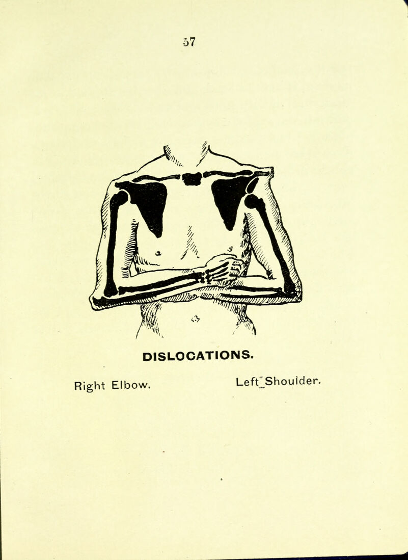 1 57 DISLOCATIONS. Right Elbow. Left Shoulder. m