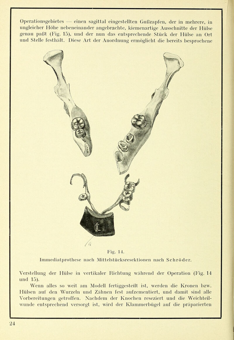 Operationsgebietes — einen sagittal eingestellten Gußzapfen, der in mehrere, in ungleicher Höhe nebeneinander angebrachte, kiemenartige Ausschnitte der Hülse genau paßt (Fig. 15), und der nun das entsprechende Stück der Hülse an Ort und Stelle festhält. Diese Art der Anordnung ermöglicht die bereits besprochene Fig. 14. Immediatprothese nach Mittelstücksresektionen nach Schröder. Verstellung der Hülse in vertikaler Richtung während der Operation (Fig. 14 und 15). Wenn alles so weit am Modell fertiggesteilt ist, werden die Kronen bzw. tlülsen auf den Wurzeln und Zähnen fest aufzementiert, und damit sind alle Vorbereitungen getroffen. Nachdem der Knochen reseziert und die Weichteil- wunde entsprechend versorgt ist, wird der Klammerbügel auf die präparierten