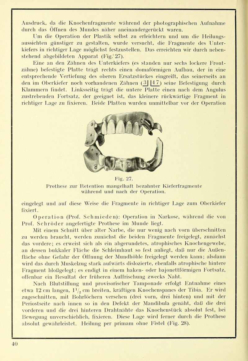 Ausdruck, da die Kiiocheufragmeute während der pliotographischen Aufnahme durch das Öffnen des INfundes näher aneinandergerückt waren. Um die Operation der Plastik selbst zu erleichtern und um die Heihmgs- aussichten günstiger zu gestalten, wurde versucht, die Fragmente des Unter- kiefers in richtiger Lage möglichst festzustellen. Das erreichten wir durch neben- stehend abgebildeten Apparat (Fig.'27). Eine an den Zähnen des Unterkiefers (es standen nur sechs lockere Front- zälme) befestigte Platte trägt rechts einen domaförmigen Aufbau, der in eine entsprechende Vertiefung des oberen Ersatzstückes eingreift, das seinerseits an den im Oberkiefer noch vorhandenen Zähnen (_^ |4 7) seine Befestigung durch Klammern findet. Linksseitig trägt die untere Platte einen nach dem Angulus zustrebenden Fortsatz, der geeignet ist, das kleinere rückwärtige Fragment in richtiger Lage zu fixieren. Beide Platten wurden unmittelbar vor der Operation Fig. 27. Prothese zur Retention mangelhaft bezahnter Kieferfragmente während und nach der Oi)eration. eingelegt und auf diese Weise die Fragmente in richtiger Lage zum Oberkiefer fixiert. Operation (Prof. Schmieden): Operation in Narkose, während die von Prof. Schröder angeferligte Prothese im Munde liegt. Mit einem Schnitt über alter Narbe, die nur wenig nach vorn überschnitten zu werden braucht, werden zunächst die beiden Fragmente freigelegt, zunächst das vordere; es erweist sich als ein abgerundetes, atrophisches Knochengewebe, an dessen bukkaler Fläche die Schleimhaut so fest anliegt, daf3 nur die Außen- fläche ohne Gefahr der Öffnung der Mundhöhle freigelegt werden kann; alsdann wird das durch Mnskelzng stark aufwärts dislozierte, ebenfalls atrophische hintere PYagment bloßgelegt; es endigt in einem haken- oder bajonettförmigeii Fortsatz, offenbar ein Resultat der früheren Auffrischung zwecks Naht. Nach Blutstillung und provisorischer Tamponade erfolgt Entnahme eines etwa 12 cm langen, cm breiten, kräftigen Knochenspanes der Tibia. Er wird zngeschnitten, mit Bohrlöchern versehen (drei vorn, drei hinten) und mit der Periostseite nach innen so in den Defekt der iMandibnla genäht, daß die drei vorderen und die drei hinteren Drahtnähte das Knochenstück absolut fest, bei Bewegung imverschieblich, fixieren. Diese Lage wird ferner durch die Prothese absolut gewährleistet. Heilung per primam ohne Fistel (Fig. 28).