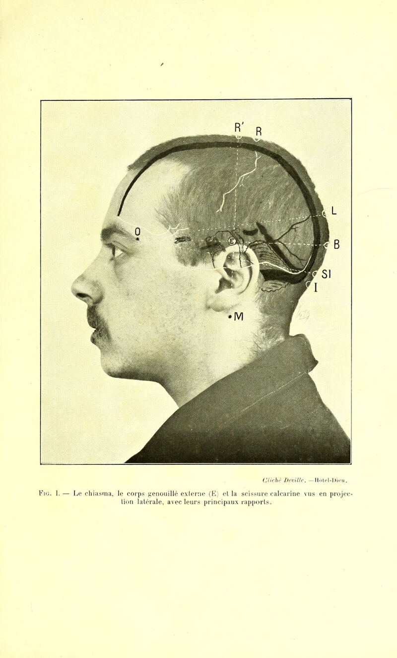 Clirhr Dcvilk. — Hôtel-Dieu. Fig. 1. — [>e chitisma, le coi'ps genouillé exlerne (K) el la scissure calcarine vus en projcc' lion latérale, avec leurs principaux rappi.irls.