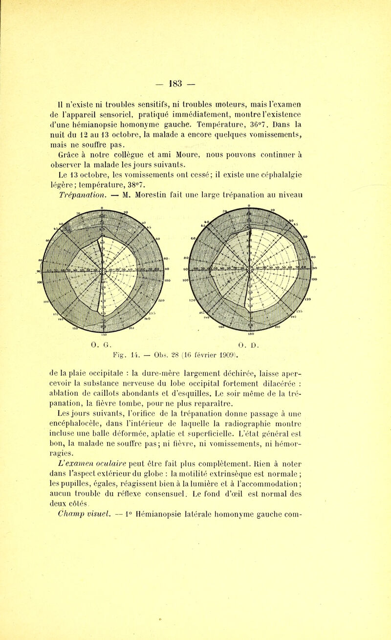 11 n’existe ni troubles sensitifs, ni troubles moteurs, mais l’examen de l’appareil sensoriel, pratiqué immédiatement, montre l’existence d’une hémianopsie homonyme gauche. Température, 36°7. Dans la nuit du 12 au 13 octobre, la malade a encore quelques vomissements, mais ne souffre pas. Grâce à notre collègue et ami Moure, nous pouvons continuer à observer la malade les jours suivants. Le 13 octobre, les vomissements ont cessé; il existe une céphalalgie légère; température, 38°7. Trépanation. — M, Morestin fait une large trépanation au niveau de la plaie occipitale ; la dure-mère largement déchirée, laisse aper- cevoir la substance nerveuse du lobe occipital fortement dilacérée : ablation de caillots abondants et d’esquilles. Le soir même de la tré- panation, la fièvre tombe, pour ne plus reparaître. Les jours suivants, l’orifice de la trépanation donne passage à une encéphalocèle, dans l’intérieur de laquelle la radiographie montre incluse une balle déformée, aplatie et superficielle. L’état général est bon, la malade ne soulfrc pas; ni fièvre, ni vomissements, ni hémor- ragies. L’examen oculaire peut être fait plus complètement. Rien à noter dans l’aspect extérieur du globe : la motilité extrinsèque est normale; les pupilles, égales, réagissent bien à la lumière et à l’accommodation; aucun trouble du réflexe consensuel. Le fond d’œil est normal des deux côtés. Champ visuel. — 1° Hémianopsie latérale homonyme gauche com- 0. G. 0. D. Fig. 14. — Obs. 28 (IG février 19091.
