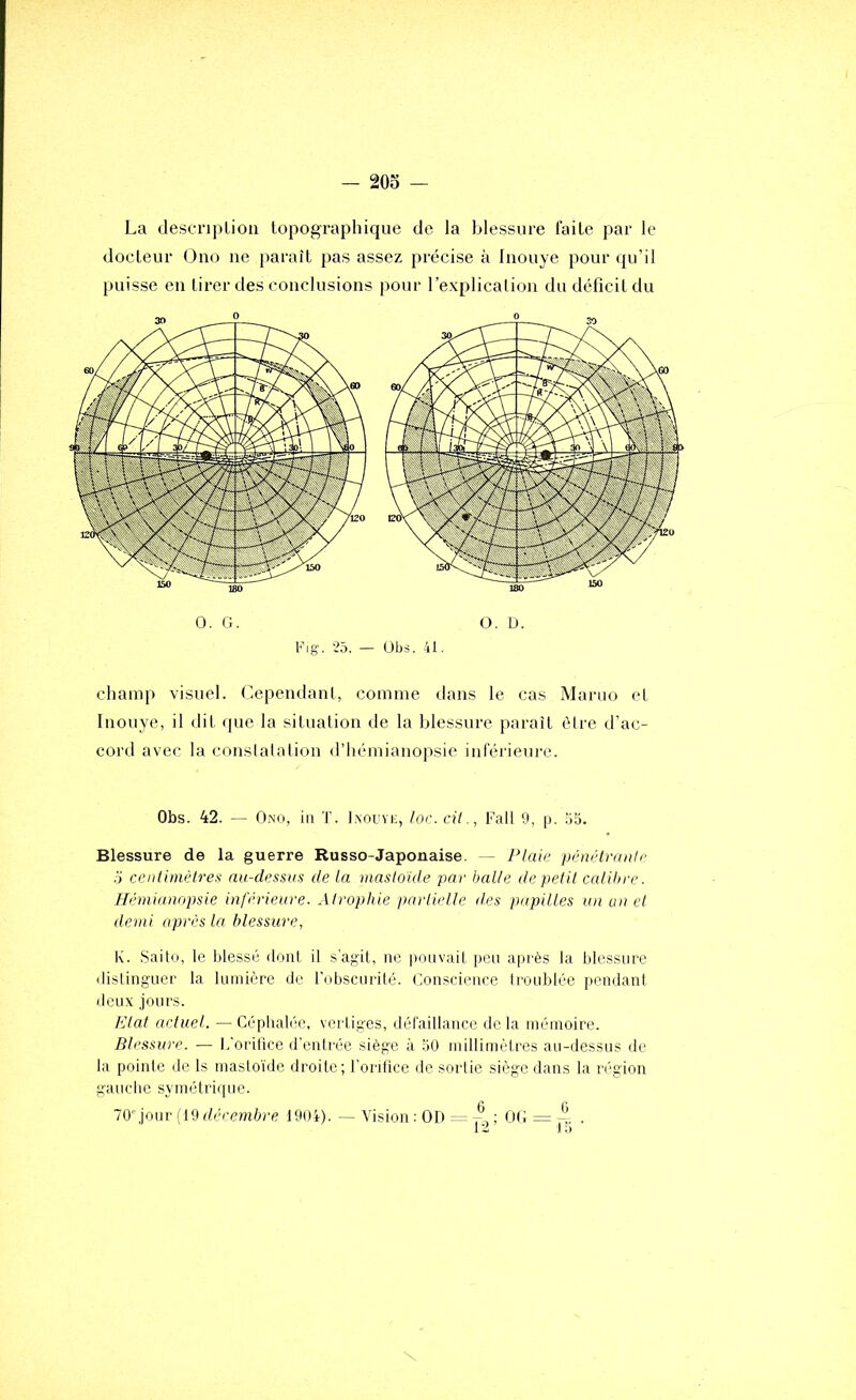 La descripliou topographique de la blessure faite par le docteur Ono ne paraît pas assez précise à Inouye pour qu’il puisse eu tirer des conclusions pour l’explicalion du déficit du O. G. O. D. IGg. 25. - Übs. 41. champ visuel. Cependant, comme dans le cas Mariio et Inouye, il dit que la situation de la blessure paraît être d’ac- cord avec la constatation d’hémianopsie inférieure. Obs. 42. — Ono, in T. I.noivi;, loc.cil., Fait 9, p. .‘iS. Blessure de la guerre Russo-Japonaise. — l^laie pénétranh- 5 centimètres nu-dessns de la mastoide par balle depetil calibre. Hémianopsie inférieure. Atrophie parlielle des papilles un un et demi après la blessure, K. Saito, le blessé dont il s'agit, ne pouvait peu ajirès la blessure dislinguei' la lumière de robscnrité. Conscience Iroublée pendanl deu.v jours. lélat actuel. — Céphalée, vertiges, défaillance delà mémoire. Blessure. — h'orifice d’entrée siège à 50 millimètres au-dessus de la pointe de Is masto'ide droite; l'ordice de sortie siège dans la région gauche symétri(pie. TO-jour {19 décembre 1904). — Vision ; 01) — p, ; OC = p .