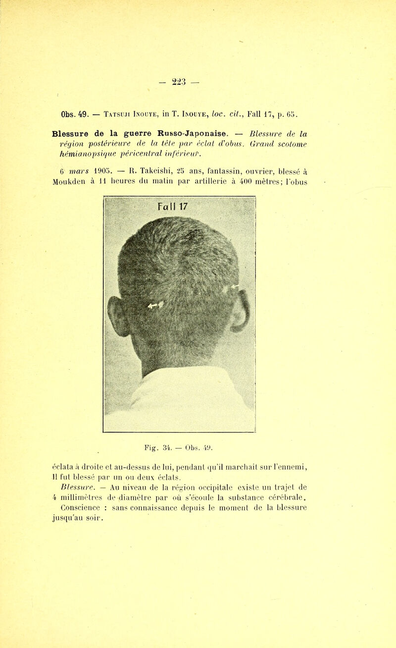 Obs. 49. — Tatsiui Inouye, in T. Iaouye, Loc. cit., Fall 17, p. ôtj. Blessure de la guerre Russo-Japonaise. — Blessure de la région postérieure de la tête par éclat d’obus. Grand scolorne hémianopsigue péricenlral inférieur'. 6 mars 1905. — H. Takeishi, 25 ans, iantassin, ouvrier, blessé à Moukden à 11 lieures du malin par arlillerie à 400 mètres; l'obus Fig. 34. — Obs. 49. éclata à droite et au-dessus de lui, pendant (pi’il marchait sur l’ennemi, 11 fut blessé par un ou deux éclats. Blessure. — Au niveau de la région occipitale existe un trajet de 4 mitlimèti’es de diamètre par où s’écoule la substance cérébrale. Conscience : sans connaissance depuis le moment de la blessure jusqu’au soir.