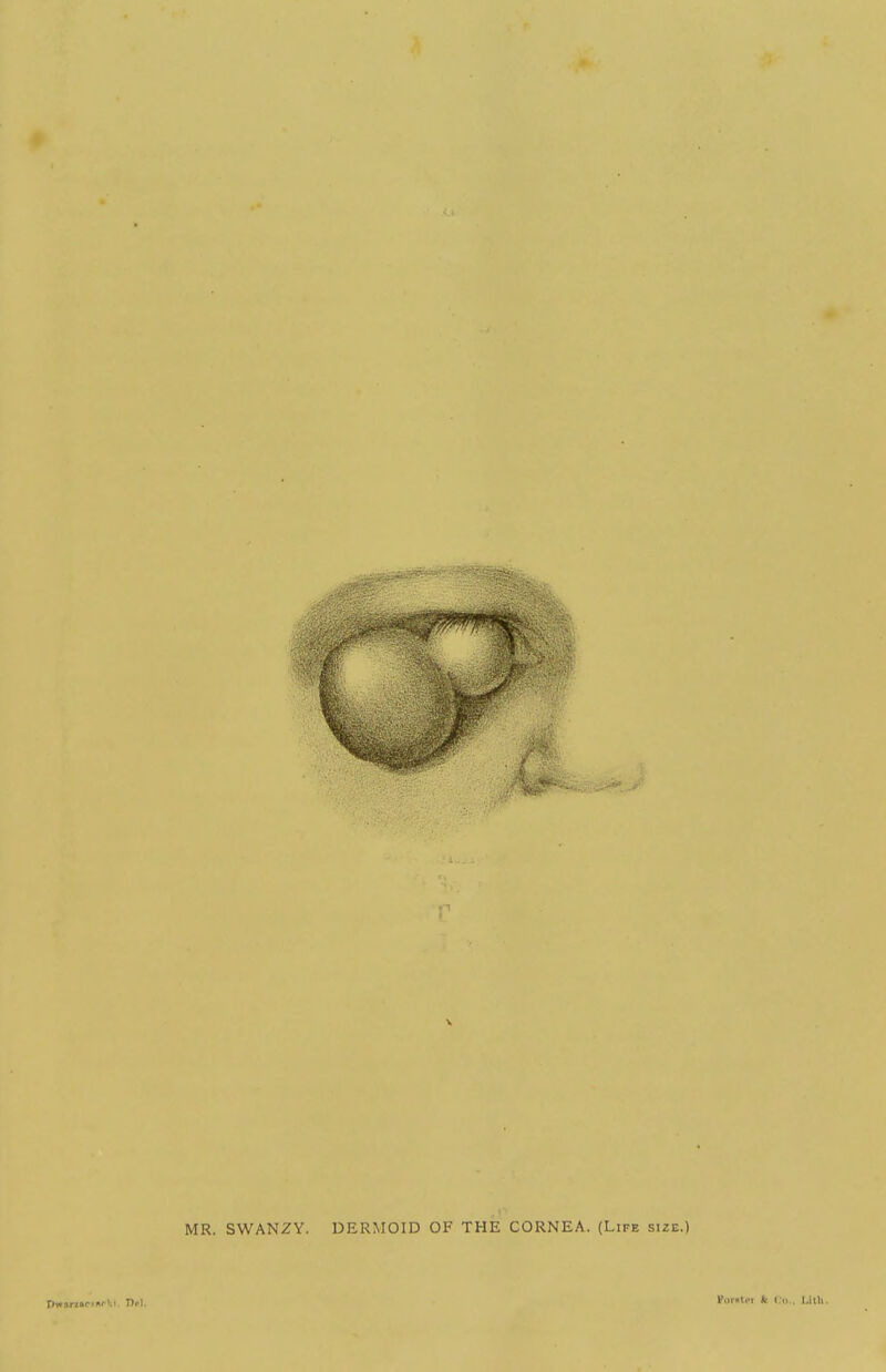MR. SWANZY. DERMOID OF THE CORNEA. (Life size.) Pofpiti'i ft Co.. UlU.