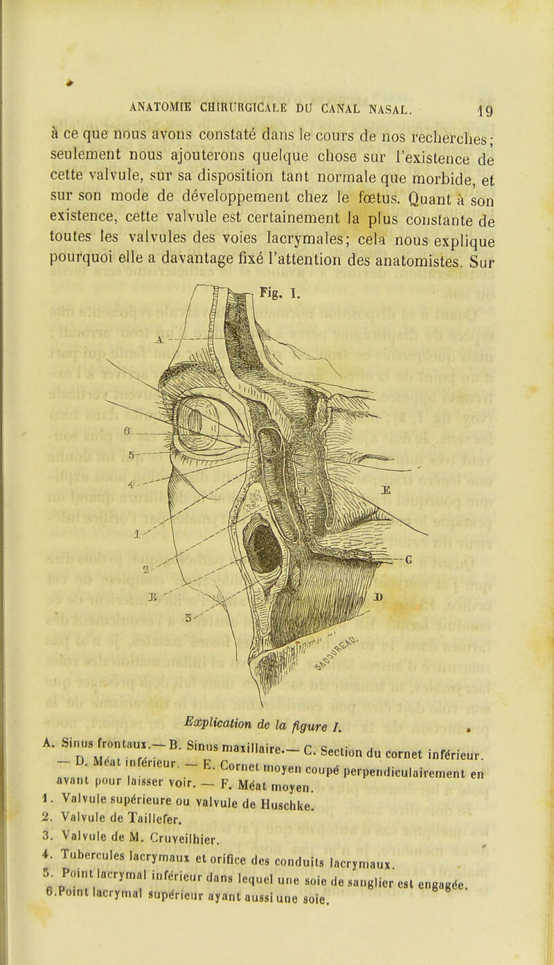 à ce que nous avons constaté dans le cours de nos recherches- seulement nous ajouterons quelque chose sur l'existence de cette valvule, sur sa disposition tant normale que morbide, et sur son mode de développement chez le fœtus. Quant à son existence, cette valvule est certainement la plus constante de toutes les valvules des voies lacrymales; cela nous explique pourquoi elle a davantage fixé l'attention des anatomistes. Sur ^Explication de la figure I. . A. Sinus frontau,.- B. Sinus maxillaire- C. Section du cornet inférieur. - D Méat nfér.eur. _ E. Cornet moyen coupé perpendiculairement en avant pour laisser voir. - F. Méat moyen. 1. Valvule supérieure ou valvule de Huschke 2. Valvule de ïaillefer. 3. Valvule de M. Cruyeilhier. 4. Tubercules lacrymaux et orifice des conduits lacrymaux 5. Point lacrymal inférieur dans lequel une soie de sanglier est engagée. e.Point lacrymal supérieur ayant aussi une soie.