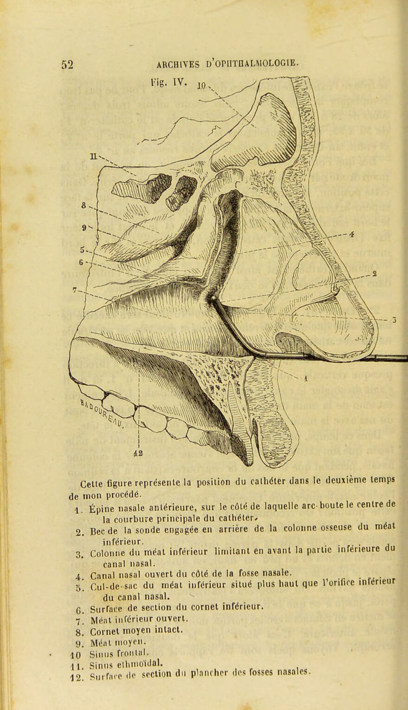 Celle figure représenle la position du calhéter dans le deuxième lemps de mon procédé. 1. Épine nasale anlérieure, sur le côlé de laquelle arc-boute le cenlre de la courbure principale du calhéler* 2. Bec de la sonde engagée en arrière de la colonne osseuse du méal inférieur. . • a 3. Colonne du méal inférieur limitant en avant la partie uiferieure du canal nasal. 4 Canal nasal ouvert du côlé de la fosse nasale, b. Cul-de-sac du méal inférieur situé plus haut que l'orifice inférieur du canal nasal. 6. Surface de section du cornet inférieur. 7. Méal inférieur ouvert. 8. Cornet moyen intact. 9. Méal moyen. 10 Sinus fionlai. 11. Sinus elhmoïdal. 12 Snrfai'c ilc section du plancher dos fosses nasales.