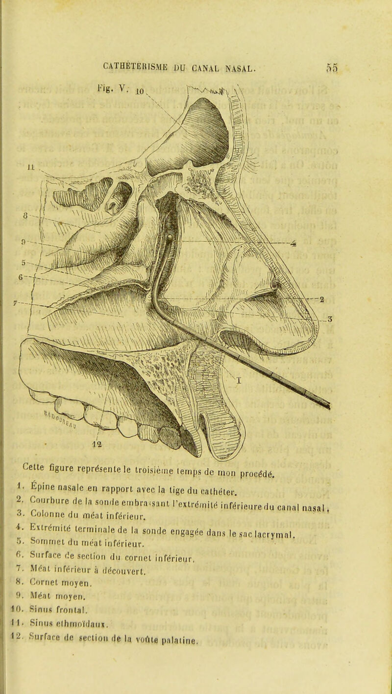 l'ig. V Cette figure représente le troisième temps de mon procédé. 1. Epine nasale en rapport avec la tige du cathéter. 2. Courbure de la sonde embrassant l'extrémité inférieure du canal nasal. à. Colonne du méat inférieur. 4. Extrémité terminale de la sonde engagée dans le sac lacrymal. 5. Sommet du méat inférieur. fi. Surface de section du cornet inférieur, 7. Méat inférieur à découvert. 8. Cornet moyen. 9. Mé/it moyen. 10. Sinus frontal. 11. Sinus elhmoïdaux. 12. Surface de section de la voMe palatine.