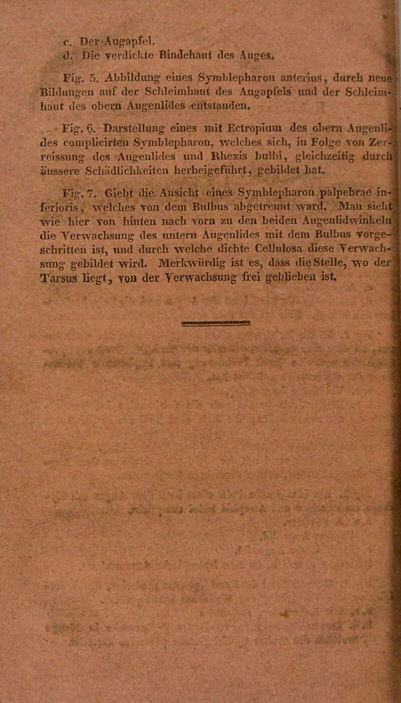 r. Dov Augapfel, <l. Die vercliclvte Bindehaut des Aun'es. Fig\ 5. AbbiUlung- eines Synil)lepharon antciiuS, tlurch neu Bildungen auf der Schleimhaut des Augapfels und der Sf liloim haut des obcm Aug-enlides entstanden. Fig-. ^. Darstellung eines mit Ectroi)ium des ohem Aug'enli- des conii)licirtein Symblepharon, v/elches sich, in Folge von Ze reissung des Augenlides und Rhexis bulln, gleichzeitig diurc äussere Schädlichkeiten herbeigeführt, gebildet hat. Fig. 7. Giebt die Ansicht eiiies Symblepharon palpebrae in ferioris, welches von dem Bulbus abgetrennt ward. Man siel wie hier von hinten nach vorn zu den beiden AugenlidwinkeJ die Verwachsung des imtern Augenlides mit dem Bulbus rorgt schritten ist, tmd durch welche dichte Cellulosa diese Yersvacli suug gebildet wii'd. Merkwürdig ist es, dass tlie Stelle, wo dc Tarsiis liegt ^ vou der Yerwachsimg frei gebliebeu ist.