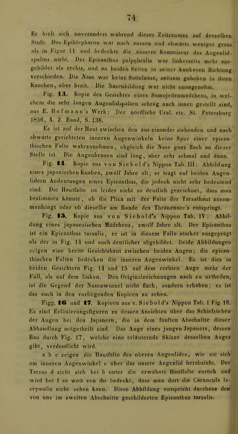 T4 Er hielt sich iinvcrändcrl wahrend dieses Zeitraumes auf derselben Slulc. Das E|)il)lf|)liHron war natli aussen und abwftrts weniger gross als in Figur 11 und bedecklc die äussere Kommissur des Augenlid- spalles nichl. Der Epicanlhus palpebralis war linkerseits mehr aps- gcbildel als rechls, und an beiden Seilen in seiner konkaven Hichlung verschieden. Die Nase war keine Sattelnase, sattsam gehoben in ihren Knochen, aber breit. Die Kasenbildung war nicht unangenehm. Fig. 13. Kopie des Gesichtes eines Samojedenmadchens, in wel- chem die sehr langen Augenlidspalten schräg nach innen gestellt sind, aus E. Ilofmann's Werk: Der nördliche Ural. etc. St. Petersburg 1856, 4. 2. Band, S. 138. Es ist auf der Haut zwischen den aus einander stehenden und nach abwärt.! gerichteten inneren Augenwinkeln keine Spur einer epican- Ihischcn Falte wahrzunehmen, obgleich die Nase ganz flach an dieser Stelle ist. Die Augenbrauen sind lang, aber sehr schmal und dünn. Fig. 14. Kopie aus von Siebold's Nippon Tab. III: Abbildung eines japanischen Knaben, zwölf Jahre alt; er trägt auf beiden Augen- lidern Andeutungen eines Epicanlhus, die jedoch nicht sehr bedeutend sind. Die Hautfalle ist leider nicht so deutlich gezeichnet, dass man bestimmen könnte, ob die Plica mit der Falte der Tarsalhaut zusam- menhängt oder ob dieselbe am Rande des Thränensec's entspringt. Fig. 15. Kopie aus von Siebold's Nippon Tab. IV: Abbil- , dung eines japanesischen Mädchens, zwölf Jahre alt. Der Epicanlhus ist ein Epicanlhus larsalis, er ist in diesem Falle stärker ausgeprägt als der in Fig. 14 und auch deutlicher abgebildet. Beide Abbildungen zeigen eine breite Gesichtshaut zwischen beiden Augen; die epican- Ihischen Falten bedecken die inneren Augenwinkel. Es ist dies in beiden Gesichtern Fig. 14 und 15 auf dem rechten Auge mehr der Fall, als auf dem linken. Den Originalzeichnungen nach zu urtheilen, ist die Gegend der Nasenwurzel nicht flach, sondern erhaben; es ist das auch in den vorliegenden Kopieen zu sehen. Figg. lO und 17. Kopieen aus v. Siebold's Nippon Tab. 1 Fig. 16. Es sind Erläuterungsfiguren zu dessen Ansichten über das Schiefslehen der Augen bei den Japanern, die in dem fünften Abschnitte dieser Abhandlung mitgelheilt sind. Das Auge eines jungen Japaners, dessen Bau durch Fig. 17, welche eine erläuternde Skizze desselben Auges gibt, verdeutlicht wird. a h c zeigen die Haulfallc des oberen Augenlides, wie sie sich am inneren Augenwinkel c über das untere Augenlid herabzieht. Der Tarsus d zieht sich bei b unter die erwähnte Haulfallc zurück und wird bei f so weit von ihr bedeckt, dnss man dort die Caruncu!« In- crymalis nicht sehen kann. Diese Abbildung entspricht durchaus den von uns im zweiten Abschnitte geschilderten Epicanlhus larsalis.