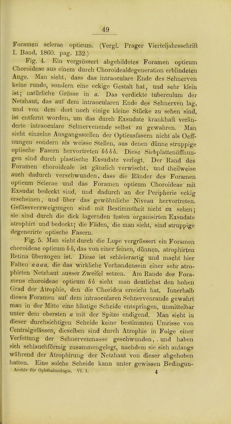 Foramen sclerae opticum. (Vergl. Prager Vierteljahrsschrift I. Band, 1860. pag. 132.) Fig. 4. Ein vergrössert, abgebildetes Foramen opticum Choroideae aus einem durch Clioroidealdegeneratiou erblindeten Auge. Man sieht, dass das intraoculare Ende des Sehnerven keine runde, sondern eine eckige Gestalt hat, und sehr klein ist; natürliche Grösse in a. Das verdickte tuberculum der Netzhaut, das auf dem intraocularen Ende des Sehnerven lag, und von dem dort noch einige kleiue Stücke zu sehen sind, ist entfernt worden, um das durch Exsudate krankhaft verän- derte intraoculare Sehuervenende selbst zu gev^^ahren. Man sieht einzelne Ausgangsstellen der Opticusfasern nicht als Oeff- nungen sondern als weisse Stellen, aus denen dünne struppige optische Fasern hervortreten Ihlh. Diese Siebplattenöffnun- gen sind durch plastische Exsudate verlegt. Der Rand des Foramen choroideale ist gänzlich verwischt, und theilweise auch dadurch verschwunden, dass die Eänder des Foramen opticum Sclerae und das Foramen opticum Choroideae mit Exsudat bedeckt sind, und dadurch an der Peripherie eckig erscheinen, und über das gewöhnliche Niveau hervortreten. Gefässverzweiguugen sind mit Bestimmtheit nicht zu sehen; sie sind durch die dick lagernden festen organisirten Exsudate atrophirt und bedeckt; die Fäden, die man sieht, sind struppige degenerirte optische Fasern. Fig. 5. Man sieht durch die Lupe vergrössert ein Foramen choroideae opticum hh, das von einer feinen, dünnen, atrophirten Retina überzogen ist. Diese ist schleierartig und macht hier Falten aaaa, die das wirkliche Vorhandensein einer sehr atro- phirten Netzhaut ausser Zweifel setzen. Am Rande des Fora- mens choroideae opticum hh sieht man deutlichst den hohen Grad der Atrophie, den die Ghoridea erreicht hat. Innerhalb dieses Foramen auf dem intraocularen Sehnervenrande gewahrt man in der Mitte eine häutige Scheide entspringen, unmittelbar unter dem obersten a mit der Spitze endigend. Man sieht in dieser durchsichtigen Scheide keine bestimmten Umrisse von Centralgefässen, dieselben sind durch Atrophie in Folge einer Verfettung der Sehnervenmasse geschwunden, . und haben sich schlauchförmig zusammengelegt, nachdem sie sich anfangs während der Atrophiruug der Netzhaut von dieser abgehoben hatten. Eine solche Scheide kann unter gewissen Bedingun- Archlv flir Ophthalmologie. VI. 1. 4