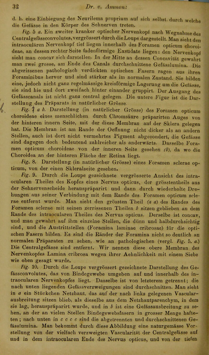 d. h. eine Einbiegung des Neurilema proprium auf sich selbst, durch welche die Gefässe in den Körper des Sehnerven treten. Fig. 5 a. Ein zweiter kranker optischer Nervenkopf nach Wegnahme des CentralgefässconvoluteSjVergrössert durch dieLoupe dargestellt. Man sieht den intraoculären Nervenkopf tief liegen innerhalb des Foramen opticura choroi- deae, an dessen rechter Seite fadenförmige Exsudate liegen: den Nervenkopf sieht man concav sich darstellen. In der Mitte an dessen Concavität gewalirt man zwei grosse, am Ende des Canals durchschnittene Gefässlumiria. Die abgerissenen pathologisch verdickten optischen Fasern ragen aus ihren Foraminibus hervor und sind stärker als im normalen Zustand. Sie bilden eine, jedoch nicht ganz regelmässige kreisförmige Lagerung um die Gefässe, sie sind hie und dort zweifach hinter einander gruppirt. Der Ausgari- des Gefässqanals ist nicht ganz central gelegen. Die untere Figur ist die Dar- stellung des Präparats in natürlicher Grösse. Fig. I ö Z». Darstellung (in natürlicher Grösse) des Foramen opticum choroideae eines menschlichen durch Chromsäure präparirten Auges von der hinteren Innern Seite, mit der diese Membran auf der Sklera gelegen hat. Die Membran ist am Rande der Oeffnung nicht dicker als an andern Stellen, auch ist dort nicht vermehrtes Pigment abgesondert, die Gefässe sind dagegen doch bedeutend zahlreicher als anderwärts. Dasselbe Fora- men opticum choroideae von der inneren Seite gesehen ft>), da wo die Choroidea an der hinteren Fläche der Retina liegt. Fig. 8. Darstellung (in natürlicher Grösse) eines Foramen sclerae op- ticum, von der einen Skleralseite gesehen. Fig. 9. Durch die Loupe gezeichnete vergrösserte Ansicht des intra- oculären Theiles des Kopfes eines Nervus opticus, der grösstentheils aus der Sehnervenscheide herauspräparirt und dann durch wiederholte Dre- hungen aus seiner Verbindung mit dem Rande des Foramen opticum scle- rae entfernt wurde. Man sieht den grössten Theil (a a) des Randes des Foramen sclerae mit seinen zerrissenen Theilen b sitzen geblieben an dem Rande des intraoculären Theiles des Nervus opticus. Derselbe ist concav, und man gewahrt auf ihm einzelne Stellen, die dünn und halbdurchsichtig sind, und die Austrittstellen (Foramina laminae cribrosae) für die opti- schen Fasern bilden. Es sind die Ränder der Foramina nicht so deutlich an normalen Präparaten zu sehen, wie an pathologischen (vergl. Fig. 5. a) Die Centralgefässe sind entfernt. Wir nennen diese obere Membran des Nervenkopfes Lamina cribrosa wegen ihrer Aehnlichkeit mit einem Siebe wie oben gesagt wurde» Fig. 10. Durch die Loupe vergrössert gezeichnete Darstellung des Ge- fässconVolutes, das von Bindegewebe umgeben auf und innerhalb des in- traoculären Nervenkopfes liegt. Dasselbe ist von letzterem getrennt; die nach unten liegenden Gefässverzweigungen sind durchschnitten. Man sieht in a ein Stückchen Netzhaut, das auf der nach links gelegenen Vascular- ausbreitung sitzen blieb, als dieselbe aus dem Netzhautparenchym, in dem sie lag, herauspräparirt wurde, und in b ist eine Gefässausbreitung zu se- hen, an der an vielen Stellen Bindegewebsfasern in grosser Menge hafte- ten ; nach unten in c c c c sind die abgetrennten und durchschnittenen Ge- fässluraina. Man bekommt durch diese Abbildung eine naturgemässe Vor- stellung von der vielfach verzweigten Vascularität der Centralgerässe auf und in dem intraoculären Ende des Nervus opticus, und von der tiefen