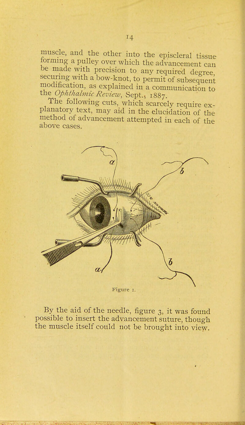 H muscle, and the other into the episcleral tissue iorming a pulley over which the advancement can be made with precision to any required degree securing with a bow-knot, to permit of subsequent modification, as explained in a communication to the Ophthalmic Review, Sept., 1887. The following cuts, which scarcely require ex- planatory text, may aid in the elucidation of the niethod of advancement attempted in each of the above cases. Figure i. By the aid of the needle, figure 3, it was found possible to insert the advancement suture, though the muscle itself could not be brought into view.