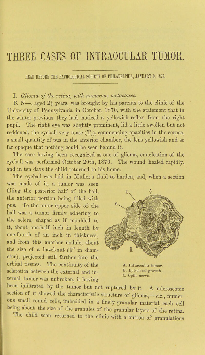 THREE CASES OF INTRAOCULAR TUMOR. READ BEFORE TflE PATHOLOGICAL SOCIETY OF PHILADELPHIA, JANDART 9, 1873. I. Glioma of the retina, with numerous metastases. B. N—, aged 2| years, was brought by his parents to the clinic of the University of Pennsylvania in October, 1870, with the statement that in the winter previous they had noticed a yellowish reflex from the right pupil. The right eye was slightly prominent, lid a little swollen but not reddened, the eyeball very tense (T^), commencing opacities in the cornea, a small quantity of pus in the anterior chamber, the lens yellowish and so far opaque that nothing could be seen behind it. The case having been recognized as one of glioma, enucleation of the eyeball was performed October 20th, 1870, The wound healed rapidly, and in ten days the child returned to his home. The eyeball was laid in Miiller's fluid to harden, and, when a section was made of it, a tumor was seen filling the posterior half of the ball, the anterior portion being filled with pus. To the outer upper side of- the ball was a tumor firmly adhering to the sclera, shaped as if moulded to it, about one-half inch in length by one-fourth of an inch in thickness; and from this another nodule, about the size of a hazel-nut (| in diam- eter), projected still farther into the orbital tissues. The continuity of the sclerotica between the external and in- ternal tumor was unbroken, it having been infiltrated by the tumor but not ruptured by it. A microscopic section of it showed the characteristic structure of glioma,—viz., numer- ous small round cells, imbedded in a finely granular material, each cell being about the size of the granules of the granular layers of the retina. The child soon returned to the clinic with a button of granulations A. Intraocular tumor. B. E|)i,scleral growth.