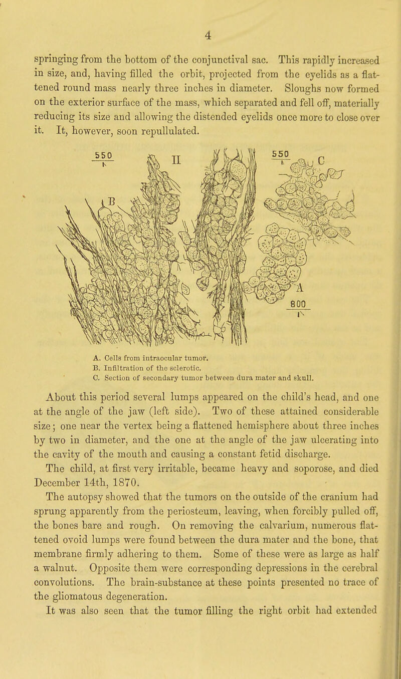 springing from the bottom of the conjunctival sac. This rapidly increased in size, and, having filled the orbit, projected from the eyelids as a flat- tened round mass nearly three inches in diameter. Sloughs now formed on the exterior surface of the mass, which separated and fell off, materially reducing its size and allowing the distended eyelids once more to close over it. It, however, soon repullulated. A. Cells from intraocular tumor. B. Infiltration of tho sclerotic. C. Section of secondary tumor between dura mater and sknll. About this period several lumps appeared on the child's head, and one at the angle of the jaw (left side). Two of these attained considerable size; one near the vertex being a flattened hemisphere about three inches by two in diameter, and the one at the angle of the jaw ulcerating into the cavity of the mouth and caitsing a constant fetid discharge. The child, at first very irritable, became heavy and soporose, and died December 14th, 1870. The autopsy showed that the tumors on the outside of the cranium had sprung apparently from the periosteum, leaving, when forcibly pulled oiF, the bones bare and rough. On removing the calvarium, numerous flat- tened ovoid lumps were found between the dura mater and the bone, that membrane firmly adhering to them. Some of these were as large as half a walnut. Opposite them were corresponding depressions in the cerebral convolutions. The brain-substance at these points presented no trace of the gliomatous degeneration. It was also seen that the tumor filling the right orbit had extended