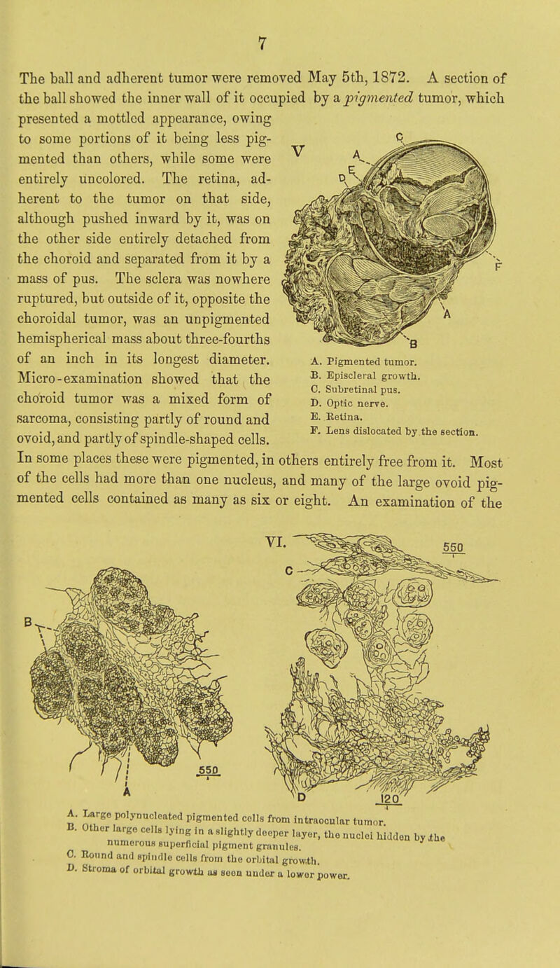 The ball and adherent tumor were removed May 5th, 1872. A section of the ball showed the inner wall of it occupied by a, pigmented tumor, which presented a mottled appearance, owing to some portions of it being less pig- mented than others, while some were entirely uncolored. The retina, ad- herent to the tumor on that side, although pushed inward by it, was on the other side entirely detached from the choroid and separated from it by a mass of pus. The sclera was nowhere ruptured, but outside of it, opposite the choroidal tumor, was an unpigmented hemispherical mass about three-fourths of an inch in its longest diameter. Micro-examination showed that the choroid tumor was a mixed form of sarcoma, consisting partly of round and ovoid, and partly of spindle-shaped cells. In some places these were pigmented, in others entirely free from it. Most of the cells had more than one nucleus, and many of the large ovoid pig- mented cells contained as many as six or eight. An examination of the A. Pigmented tumor. B. Episcleral growth. C. Subretlnal pus. D. Optic nerve. B. Eetlna. F. Lens dislocated by the section. A. Largo polynuclcatcd pigmented colls from intraocular tumor B. Other largo colls lying in a slightly deeper layer, the nuclei hidden by .the numerous superficial pigment granules. 0. Hound and spindle cells from the orlntal grow.th. D. Stroma of orbital growth as seen under a iowor power