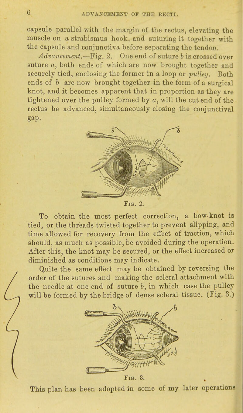 capsule parallel with the margin of the rectus, elevating the muscle on a strabismus hook, and suturing it together with the capsule and conjunctiva before separating the tendon. Advancement,—Fig. 2. One end of suture b is crossed over suture a, both ends of which are now brought together and securely tied, enclosing the former in a loop or pulley. Both ends of b are now brought together in the form of a surgical knot, and it becomes apparent that in proportion as they are tightened over the pulley formed by a, will the cut end of the rectus be advanced, simultaneously closing the conjunctival gap. Fig. 2. To obtain the most perfect correction, a bow-knot is tied, or the threads twisted together to prevent slipping, and time allowed for recovery from the effect of traction, which should, as much as possible, be avoided during the operation. After this, the knot may be secured, or the effect increased or diminished as conditions may indicate. Quite the same effect may be obtained by reversing the order of the sutures and making the scleral attachment with the needle at one end of suture 6, in which case the pulley will be formed by the bridge of dense scleral tissue. (Fig. 3.) Fio. 3. This plan has been adopted in some of my later operations