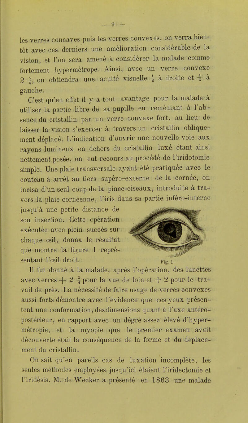 les verres concaves puis les verres convexes, on verra bien- tôt avec ces derniers une amélioration considérable de la vision, et l'on sera amené à considérer la malade comme fortement hypermétrope. Ainsi, avec un verre convexe 2 4, on obtiendra une acuité visuelle -j à droite et i à gauche. C'est qu'en effet il y a tout avantage pour la malade à utiliser la partie libre de sa pupille en remédiant à l'ab- sence du cristallin par un verre convexe fort, au lieu de laisser la vision s'exercer à travers un cristallin oblique- ment déplacé. L'indication d'ouvrir une nouvelle voie aux rayons lumineux en dehors du cristallin luxé étant ainsi nettement posée, on eut recours au procédé de l'iridotomie simple. Une plaie transversale ayant été pratiquée avec le couteau à arrêt au tiers supéro-externe de la cornée, on incisa d'un seul coup de la pince-ciseaux, introduite à tra- vers la plaie cornéenne, l'iris dans sa partie inféro-interne jusqu'à une petite distance de son insertion. Cette opération exécutée avec plein succès sur chaque œil, donna le résultat que montre la figure 1 repré- sentant l'œil droit. Il fut donné à la malade, après l'opération, des lunettes avec verres -\- 2 -f pour la vue de loin et -\- 2 pour le tra- vail de près. La nécessité de faire usage de verres convexes aussi forts démontre avec l'évidence que ces yeux présen- tent une conformation, des dimensions quant à l'axe antéro- . postérieur, en rapport avec un dégré assez élevé d'hyper- métropie, et la myopie que le premier examen avait découverte était la conséquence de la forme et du déplace- ment du cristallin. On sait qu'en pareils cas de luxation incomplète, les seules méthodes employées jusqu'ici étaient l'iridectomie et l'iridésis. M. de Wecker a présenté en 1863 une malade