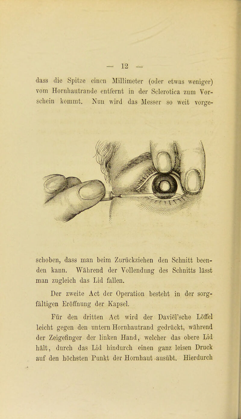 dass die Spitze einen Millimeter (oder etwas weniger) vom Hornhautrande entfernt in der Sclerotica zum Vor- schein kommt. Nun wird das Messer so weit vorge- schoben, dass man beim Zurückziehen den Schnitt been- den kann. Während der Vollendung des Schnitts lässt man zugleich das Lid fallen. Der zweite Act der Operation besteht in der sorg- fältigen Eröffnung der Kapsel. Für den dritten Act wird der Daviel'sche Löffel leicht gegen den untern Hornhautrand gedrückt, während der Zeigefinger der linken Hand, welcher das obere Lid hält, durch das Lid hindurch einen ganz leisen Druck auf den höchsten Punkt der Hornhaut ausübt. Hierdurch