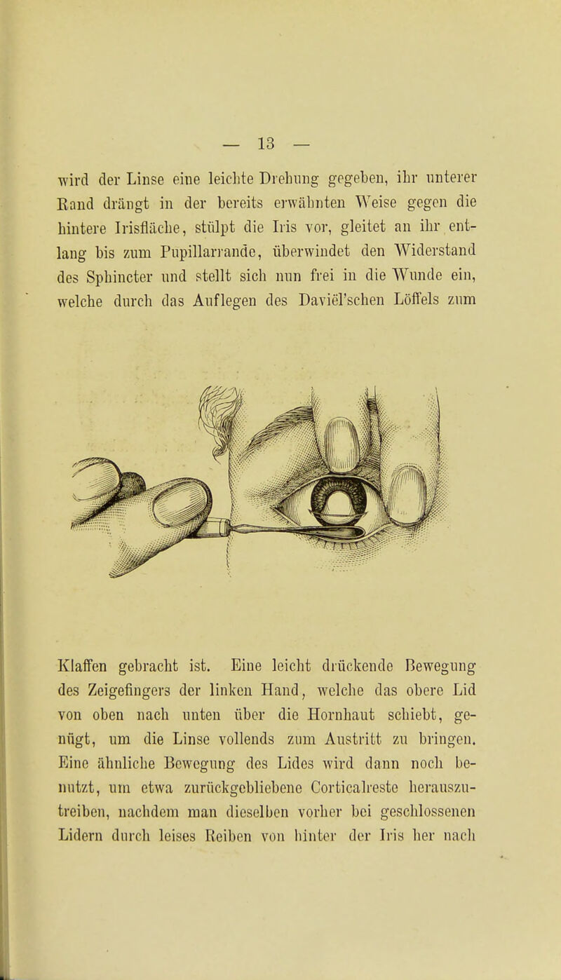 wird der Linse eine leiclite Drehung gegeben, ihr unterer Rand drängt in der bereits erwähnten Weise gegen die hintere Irisfläche, stülpt die Iris vor, gleitet an ihr ent- lang bis 7Aim Pupillarrandc, überwindet den Widerstand des Sphincter und stellt sich nun frei in die Wunde ein, welche durch das Auflegen des Daviel'schen Löffels zum Klaffen gebracht ist. Eine leicht drückende Bewegung des Zeigefingers der linken Hand, welche das obere Lid von oben nach unten über die Hornhaut schiebt, ge- nügt, um die Linse vollends zum Austritt zu bringen. Eine ähnliche Bewegung des Lides wird dann noch be- nutzt, um etwa zurückgebliebene Corticalreste herauszu- treiben, nachdem man dieselben vorher bei geschlossenen Lidern durch leises Reiben von hinter der Iris her nach