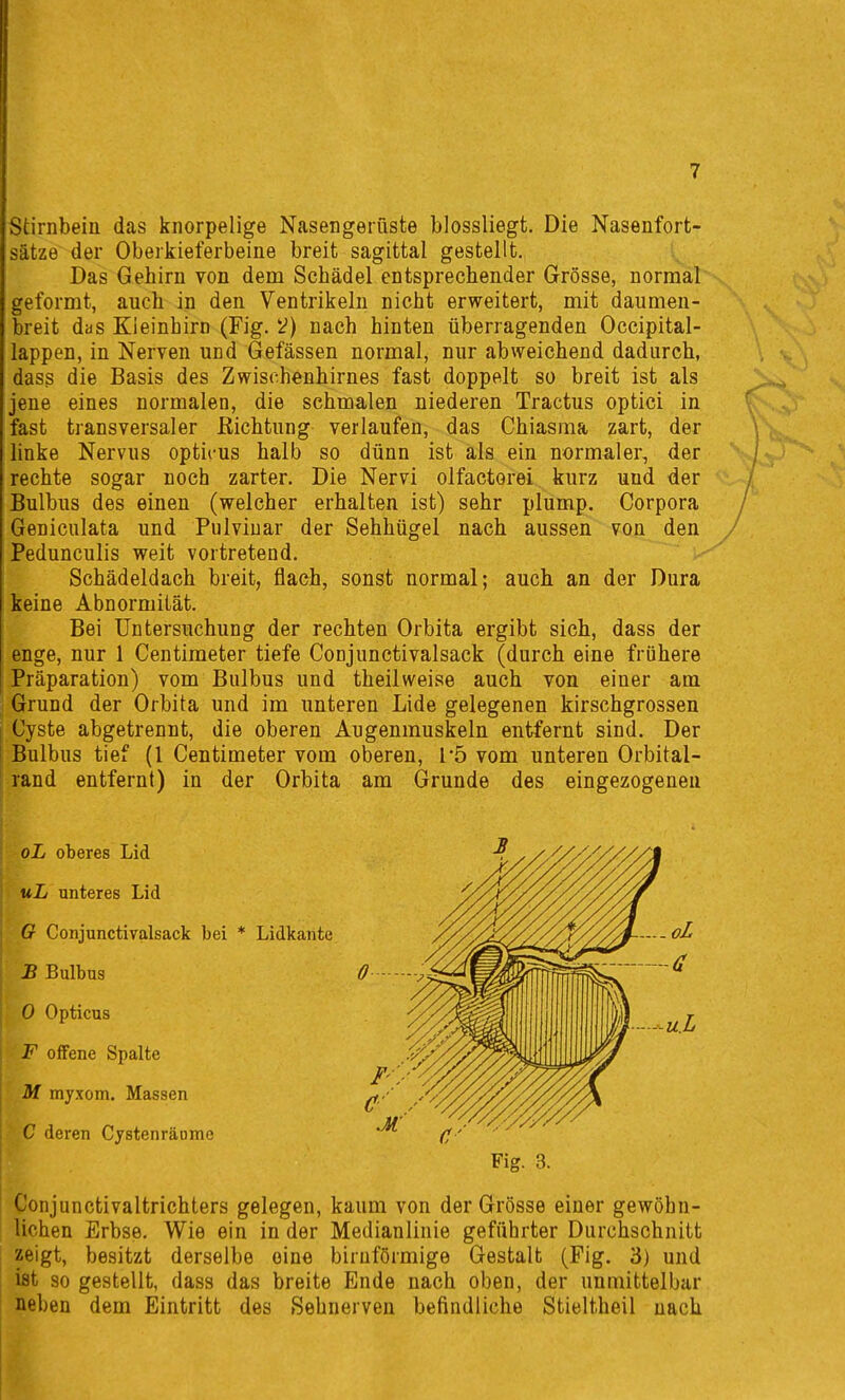 Stirnbein das knorpelige Nasengerüste blossliegt. Die Nasenfort- sätze der Oberkieferbeine breit sagittal gestellt. Das Gehirn von dem Schädel entsprechender Grösse, normal geformt, auch in den Ventrikeln nicht erweitert, mit daumen- breit das Kleinhirn (Fig. i?) nach hinten überragenden Occipital- lappen, in Nerven und Gefässen normal, nur abweichend dadurch, dass die Basis des Zwischenhirnes fast doppelt so breit ist als jene eines normalen, die schmalen niederen Tractus optici in fast transversaler Eichtung verlaufen, das Chiasma zart, der linke Nervus opticus halb so dünn ist als ein normaler, der rechte sogar noch zarter. Die Nervi olfactorei kurz und der Bulbus des einen (welcher erhalten ist) sehr plump. Corpora Geniculata und Pulviuar der Sehhügel nach aussen von den Pedunculis weit vortretend. Schädeldach breit, flach, sonst normal; auch an der Dura keine Abnormität. Bei Untersuchung der rechten Orbita ergibt sich, dass der enge, nur 1 Centimeter tiefe Conjunctivalsack (durch eine frühere Präparation) vom Bulbus und theilweise auch von einer am Grund der Orbita und im unteren Lide gelegenen kirschgrossen Cyste abgetrennt, die oberen Augenmuskeln entfernt sind. Der Bulbus tief (1 Centimeter vom oberen, 1*5 vom unteren Orbital- rand entfernt) in der Orbita am Grunde des eingezogenen oL oberes Lid uL unteres Lid G Conjunctivalsack bei * Lidkante B Bulbus 0 Opticus F offene Spalte M. myxom. Massen C deren Cjstenräome Fig. 3. Conjunctivaltrichters gelegen, kaum von der Grösse einer gewöhn- lichen Erbse. Wie ein in der Medianlinie geführter Durchschnitt zeigt, besitzt derselbe eine biruförmige Gestalt (Fig. 3) und ist so gestellt, dass das breite Ende nach oben, der unmittelbar neben dem Eintritt des Sehnerven befindliche Stieltheil nach