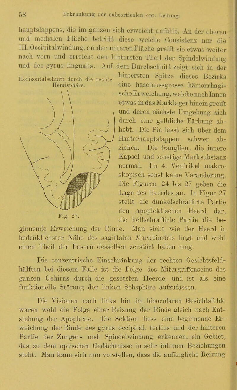 hauptslappens, die im ganzen sich erweicht anfühlt. An der oberen und medialen Fläche betrifl't diese weiche Consistenz nur die III. Occipitalwindimg, an der unteren Fläche greift sie etwas weiter nach vorn und erreicht den hintersten Theil der Spindelwindung und des gyrus lingualis. Auf dem Durchschnitt zeigt sich in der Horizontalschnitt durch die rechte hmterste» Spitze dieses Bezirks Hemisphäre. eine haselnussgrosse hämorrhagi- sche Erweichung, welche nach Innen etwas in das Marklager hinein greift und deren nächste Umgebung sich durch eine gelbliche Färbung ab- hebt. Die Pia lässt sich über dem Hinterhauptslappen schwer ab- ziehen. Die Ganglien, die innere Kapsel und sonstige Marksubstanz normal. Im 4. Ventrikel makro- skopisch sonst keine Veränderung. Die Figuren 24 bis 27 geben die Lage des Heerdes an. In Figur 27 stellt die dunkelschraffirte Partie den apoplektischen Heerd dar, die hellschraffirte Partie die be- ginnende Erweichung der Binde. Man sieht wie der Heerd in bedenklichster Nähe des sagittalen Markbündels liegt und wohl einen Theil der Fasern desselben zerstört haben mag. Die conzentrische Einschränkung der rechten Gesichtsfeld- hälften bei diesem Falle ist die Folge des Mitergriffenseins des ganzen Gehirns durch die gesetzten Heerde, und ist als eine funktionelle Störung der linken Sehsphäre aufzufassen. Die Visionen nach links hin im binocularen Gesichtsfelde waren wohl die Folge einer Beizimg der Binde gleich nach Ent- stehung der Apoplexie. Die Sektion Hess eine beginnende Er- weichung der Binde des gyrus occipital. tertius und der hinteren Partie der Zungen- und Spindelwindung erkennen, ein Gebiet, das zu dem optischen Gedächtnisse in sehr intimen Beziehungen steht. Man kann sich nun vorstellen, dass die anfängliche Beizimg