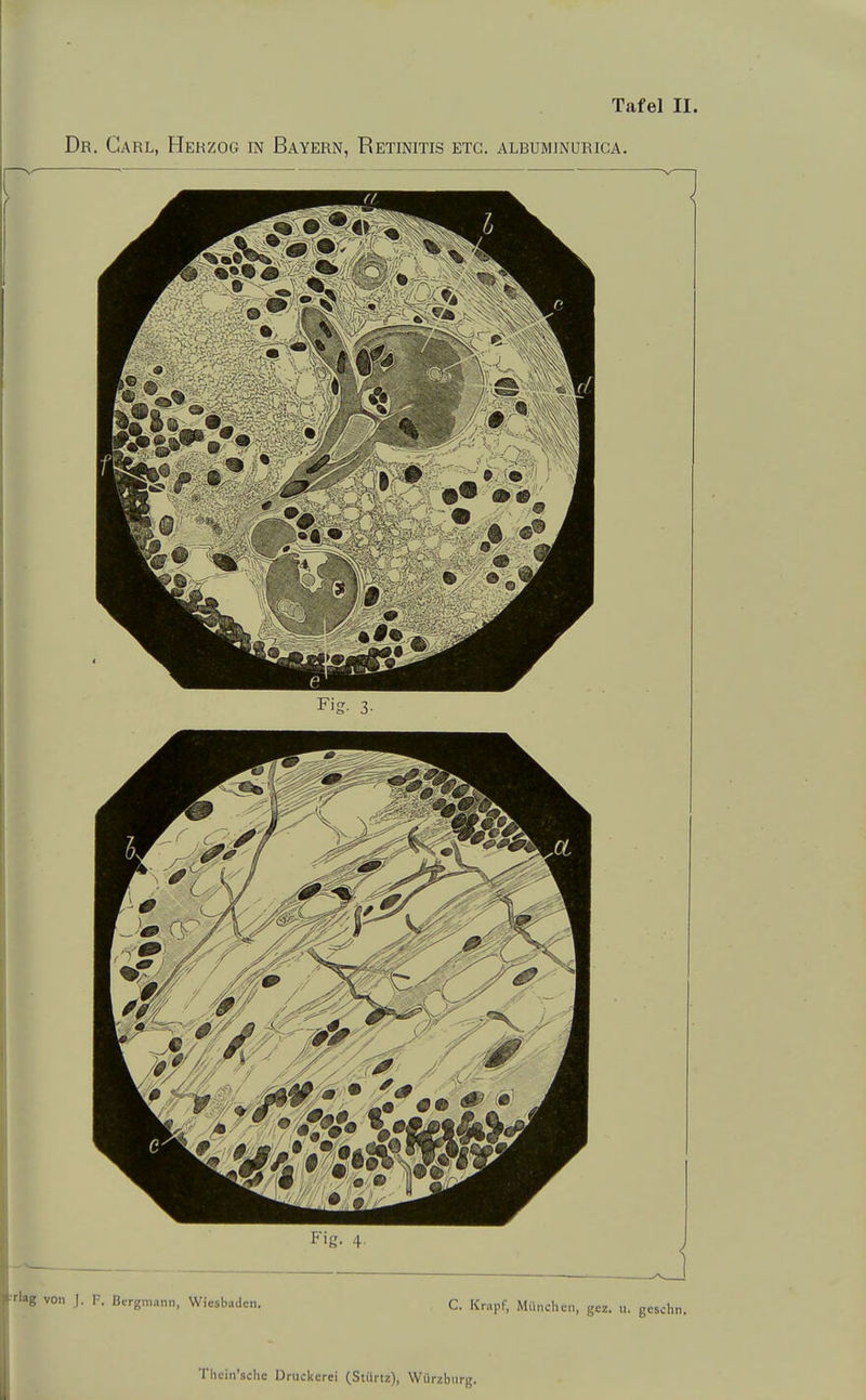 Dr. Carl, Herzog in Bayern, Retinitis etc. albuminurica. .1. F. Bergmann, Wiesbaden. C. Krapf, Miiiichcii, gez. u. gcschn.