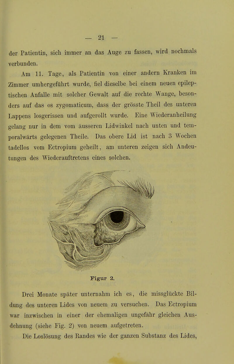 der Patientin, sich immer an das Auge zu fassen, wird nochmals verbunden. Am 11. Tage, als Patientin von einer andern Kranken im Zimmer umhergeführt wurde, fiel dieselbe bei einem neuen epilep- tischen Anfalle mit solcher Gewalt auf die rechte Wange, beson- ders auf das os zygomaticum, dass der grösste Theil des unteren Lappens losgerissen und aufgerollt wurde. Eine Wiederanheilung gelang nur in dem vom äusseren Lidwinkel nach unten und tem- poralwärts gelegenen Theile. Das obere Lid ist nach 3 Wochen tadellos vom Ectropium geheilt, am unteren zeigen sich Andeu- tungen des Wiederauftretens eines solchen. Figur 2. Drei Monate später unternahm ich es, die missglückte Bil- dung des unteren Lides von neuem zu versuchen. Das Ectropium war inzwischen in einer der ehemaligen ungefähr gleichen Aus- dehnung (siehe Fig. 2) von neuem aufgetreten. Die Loslösung des Kandes wie der ganzen Substanz des Lides,