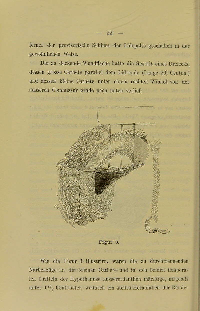 ferner der provisorische Schluss der Lidspalte geschahen in der gewöhnlichen Weise. Die zu deckende Wundfläche hatte die Gestalt eines Dreiecks, dessen grosse Cathete parallel dem Lidrande (Länge 2,6 Centim.) und dessen kleine Cathete unter einem rechten Winkel von der äusseren Commissur grade nach unten verlief. Figur 3. Wie die Figur 3 illustrirt, waren die zu durchtrennenden Narbenzüge an der kleinen Cathete und in den beiden tempora- len Dritteln der Hypothenuse ausserordentlich mächtige, nirgends unter l'/a Conti meter, wodurch ein steiles Herabfallen der Ränder