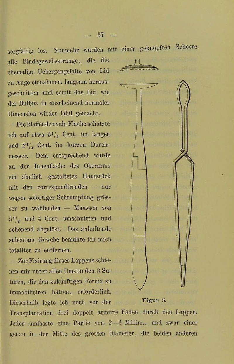sorgfältig los. Nunmehr wurden mit einer geknöpften Scheere alle Bindegewebsstränge, die die ehemalige Uebergangsfalte von Lid zu Auge einnahmen, langsam heraus- geschnitten und somit das Lid wie der Bulbus in anscheinend normaler Dimension wieder labil gemacht. Die klaffende ovale Fläche schätzte ich auf etwa 3V2 Gent im langen und 21/2 Cent, im kurzen Durch- messer. Dem entsprechend wurde an der Innenfläche des Oberarms ein ähnlich gestaltetes Hautstück mit den correspondirenden — nur wegen sofortiger Schrumpfung grös- ser zu wählenden — Maassen von ÖVa un(i 4 Cent, umschnitten und schonend abgelöst. Das anhaftende subcutane Gewebe bemühte ich mich totaliter zu entfernen. Zur Fixirung dieses Lappens schie- nen mir unter allen Umständen 3 Su- turen, die den zukünftigen Fornix zu immobilisiren hätten, erforderlich. Dieserhalb legte ich noch vor der Figur 5. Transplantation drei doppelt armirte Fäden durch den Lappen. Jeder umfasste eine Partie von 2—3 Millim., und zwar einer genau in der Mitte des grossen Diameter, die beiden anderen