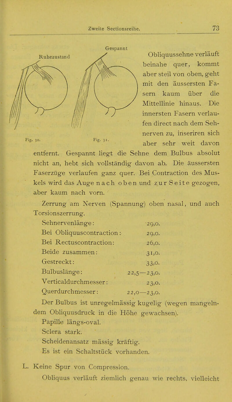 Ruhezustand Gespannt Obliquussehne verläuft beinahe quer, kommt aber steil von oben, geht mit den äussersten Fa- sern kaum über die Mittellinie hinaus. Die innersten Fasern verlau- fen direct nach dem Seh- nerven zu, inseriren sich aber sehr weit davon entfernt. Gespannt liegt die Sehne dem Bulbus absolut nicht an, hebt sich vollständig davon ab. Die äussersten Faserzüge verlaufen ganz quer. Bei Coiitraction des Mus- kels wird das Auge nach oben und zur Seite gezogen, aber kaum nach vorn. Zerrung am Nerven (Spannung) oben nasal, und auch Torsionszerrung. 30, Fig. Sehnervenlänge: Bei Obliquuscontraction: Bei Rectuscontraction: Beide zusammen: Gestreckt: Bulbuslänge: Verticaldurchmesser: Querdurchmesser: 29,0. 2g,o. 26,0. 31.0. 33,0. 22,5 — 23,0. 23,0. 22,0—23,0. Der Bulbus ist unregelmässig kugelig (wegen mangeln- dem ObHquusdruck in die Höhe gewachsen). Papille längs-oval. Sclera stark. Scheidenansatz massig kräftig. Es ist ein Schaltstück vorhanden. Keine Spur von Compression. Obliquus verläuft ziemlich genau wie rechts, vielleicht