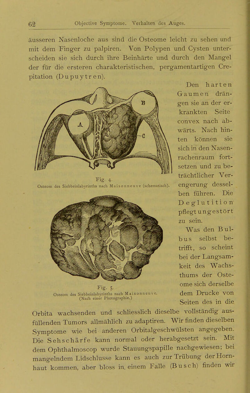 Fig. 4. Osteom des Siebbeinlabyrinths nach M a i s o n n e u v e (scberaatisch). äusseren Nasenloche aus sind die Osteome leicht zu sehen und mit dem Finger zu palpiren. Von Polypen und Cysten unter- scheiden sie sich durch ihre Beinhärte und durch den Mangel der für die ersteren charakteristischen, pergamentartigen Cre- pitation (Dupuytren). Den harten Gaumen drän- gen sie an der er- krankten Seite convex nach ab- wärts. Nach hin- ten können sie sich in den Nasen- rachenraum fort- setzen und zu be- trächtlicher Ver- engerung dessel- ben führen. Die Deglutition pflegtungestört zu sein. Was den Bul- bus selbst be- trifft, so scheint bei der Langsam- keit des Wachs- thums der Oste- ome sich derselbe dem Drucke von Seiten des in die Orbita wachsenden und schliesslich dieselbe vollständig aus- füllenden Tumors allmähhch zu adaptiren. Wir finden dieselben Symptome wie bei anderen Orbitalgeschwülsten angegeben. Die Sehschärfe kann normal oder herabgesetzt sein. Mit dem Ophthalmoscop wurde Stauungspapille nachgewiesen; bei mangelndem Lidschlusse kann es auch zur Trübung der Horn- haut kommen, aber bloss in. einem Falle (Busch) finden wir Fig. 5- Osteom des Siebbeinlabyrinths nach Maisonneu' (Nach einer Photographie.)
