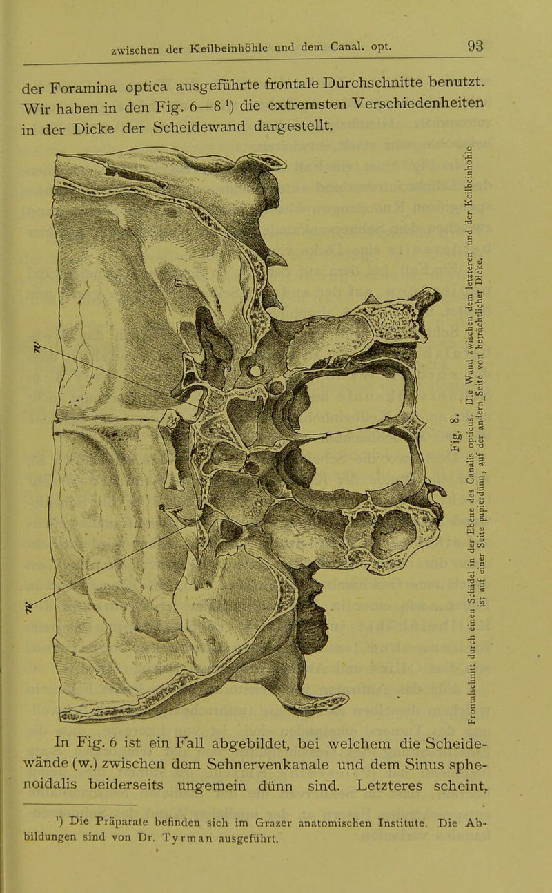 der Foramina optica ausgeführte frontale Durchschnitte benutzt. Wir haben in den Fig. 6—8 0 die extremsten Verschiedenheiten in der Dicke der Scheidewand dargestellt. In Fig. 6 ist ein Fall abgebildet, bei welchem die Scheide- wände (w.) zwischen dem Sehnervenkanale und dem Sinus sphe- noidalis beiderseits ungemein dünn sind. Letzteres scheint, ') Die Präparate befinden sich im Grazer anatomischen Institute. Die Ab- bildungen sind von Dr. Tyrman ausgeführt.