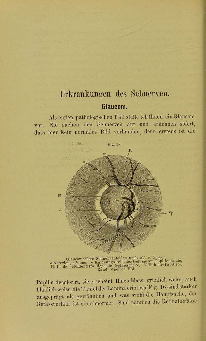 Erkrankungen des Sehnerven. Glaucom. Als ersten pathologischen Fall stelle ich Ihnen ein Glaucom vor. Sie suchen den Sehnerven auf und erkennen sofort, dass hier kein normales Bild vorhanden, denn erstens ist die Fig. 13. St. Glaucomatöses Sebnervenleiden nsch v. y^'g-'r- a Arterien Tvenen. AKnickuBgsstelle der Gefässe am Papi lenmna^^^ in der Höhlentiefa liegende Gefassstuoke, J/Holilen-(PapiUen J Rand, gelber Hof. Papille decolorirt, sie erscheint Ihnen hlass, grünlich weiss, auch bläulich weiss, die Tüpfel der Lamina cribrosa(Fig. 16) sind stärker ausgeprägt als gewöhnlich und was wohl die Hauptsache, der Gefässverlauf ist ein abnormer. Sind nämlich die Retinalgefässe