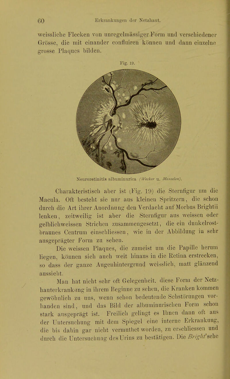 weissliche Flecken von iinrcg'elmässifi,er Form und verschiedener Grösse, die mit einander confiniren iiönnen und dann einzelne grosse Plaques bilden. Fig. l'J. Neuroretinitis albuminurica (l'^tcier u. Masseion). Charakteristisch aber ist (Fig-. 19) die Slerufigur um die Macula. Oft besteht sie nur aus kleinen Spritzern, die schon durch die Art ihrer Anordnung den Verdacht auf Morbus Brightii lenken, zeitweilig ist aber die Sternfigur aus weissen oder gelblichweissen Strichen zusammengesetzt, die ein diuikelrost- braunes Centrum einschliessen, wie in der Abbildung in sehr ausgeprägter Form zu sehen. Die weissen Plaques, die zumeist um die Papille herum liegen, können sich auch weit hinaus in die Retina erstrecken, so dass der ganze Angeuhintergrund weisslich, matt glänzend aussieht. Man hat nicht sehr oft Gelegenheit, diese Form der Netz- hauterkrankang in ihrem Heginne zu sehen, die Kranken kommen gewöhnlich zu uns, wenn schon bedeutende Sehstörungen vor- handen sind, und das Bild der albuminurischen Form schon stark ausgeprägt ist. Freilich gelingt es Ihnen dann oft aus der Untersuchung mit dem Spiegel eine interne Erkrankung, die bis dahin gar nicht vermuthet worden, zu erschliessen und durch die Untersuchung des Urins zu bestätigen. Die ;5/7;^///'schc