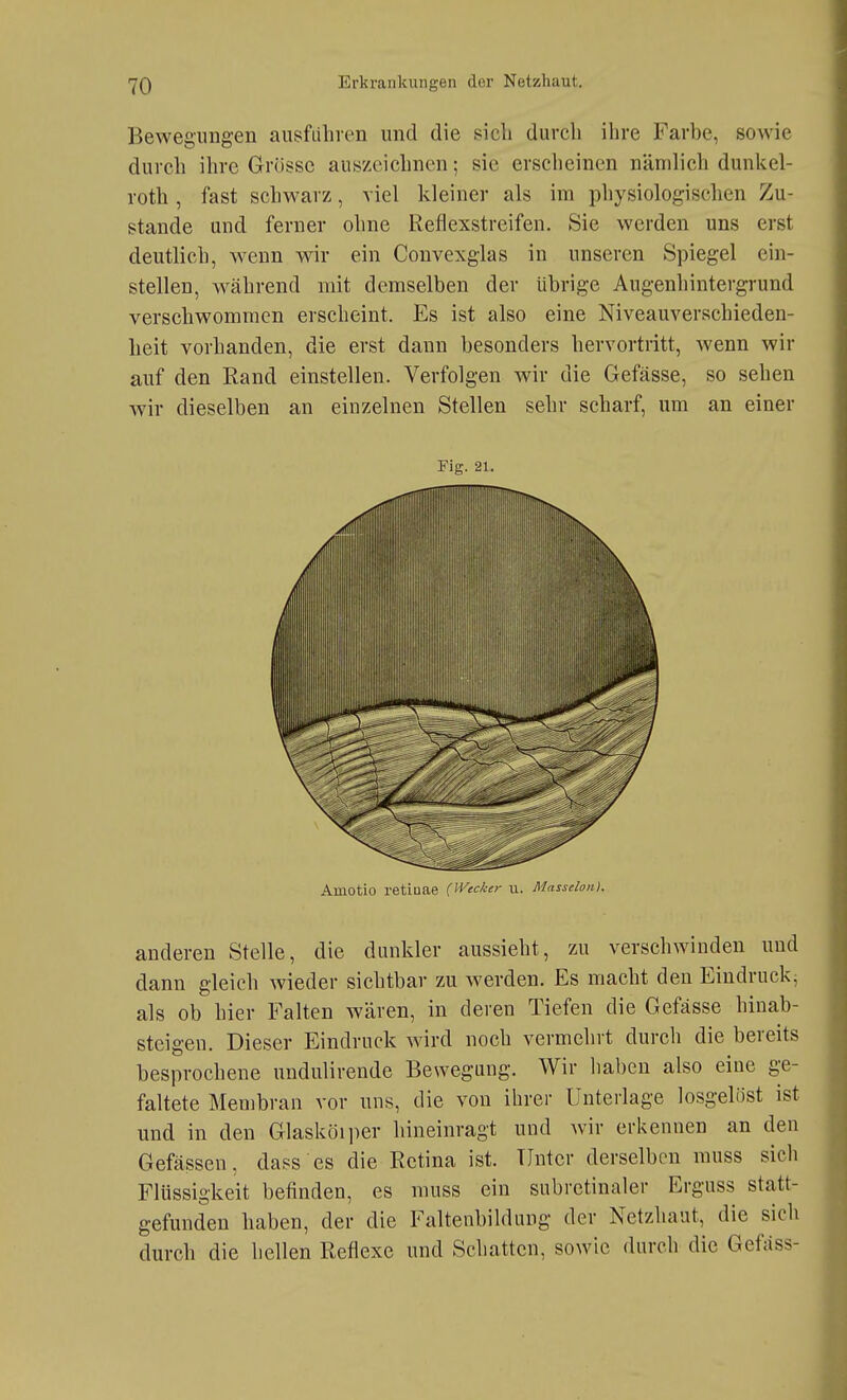 Bewegungen ausführen und die sicli durch ihre Farhe, sowie durch ihre Grösse auszeichnen; sie erscheinen nämlich dunkel- roth , fast schAvarz, viel kleiner als im physiologischen Zu- stande und ferner ohne Reflexstreifen. Sie werden uns erst deutlich, w^enn wir ein Convexglas in unseren Spiegel ein- stellen, während mit demselben der übrige Augenhintergrund verschwommen erscheint. Es ist also eine Niveauverschieden- heit vorhanden, die erst dann besonders hervortritt, wenn wir auf den Rand einstellen. Verfolgen wir die Gefässe, so sehen wir dieselben an einzelnen Stellen sehr scharf, um an einer Fig. 21. Amotio retiuae (IVecker u. Masseion). anderen Stelle, die dunkler aussieht, zu verschwinden und dann gleich wieder sichtbar zu werden. Es macht den Eindruck, als ob hier Falten wären, in deren Tiefen die Gefässe hinab- steigen. Dieser Eindruck wird noch vermehrt durch die bereits besprochene undulirende Bewegung. Wir haben also eine ge- faltete Membran vor uns, die von ihrer Unterlage losgelöst ist und in den Glasköiper hineinragt und wir erkennen an den Gefässen, dass es die Retina ist. Unter derselben muss sich Flüssigkeit befinden, es muss ein subretinaler Erguss statt- gefunden haben, der die Faltenbildung der Netzhaut, die sich durch die hellen Reflexe und Schatten, sowie durch die Gefäss-