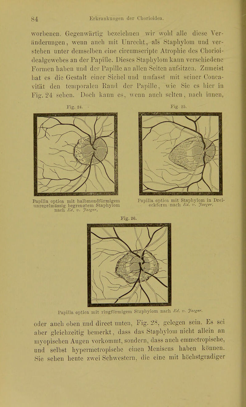 worbencn. Gegenwärtig bczeiclincii wir wohl alle diese Ver- änderungen, Avenn aucli mit Unrecht, als Stapliylom und ver- stehen unter demselben eine circumscripte Atro])liie des Chorioi- dealgewebes an der Papille. Dieses Stapbylom kann verschiedene Formen haben und der Papille an allen Seiten aufsitzen. Zumeist hat es die Gestalt einer Sichel und umfasst mit seiner Conca- vität den temporalen Rand der Pa])ille, wie Sie es hier in Fia'. 24 sehen. Doch kann es. wenn auch selten, nach innen, Fig. 24. Fig. 25. PapiUa optica mit ringförmigem Stapliylom Bach v. Jaeger. oder auch oben und direct unten, Fig. 28, gelegen sein. Es sei aber gleichzeitig bemerkt, dass das Stapbylom nicht allein an myopischen Augen vorkommt, sondern, dass auch emmetropische, und selbst hypermetropischc einen Meniscus haben können. Sie sehen heute zwei Schwestern, die eine mit hüchstgradiger