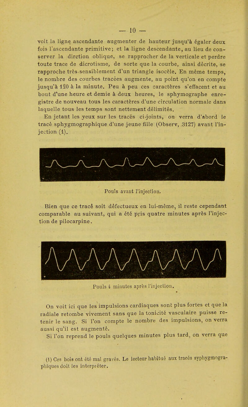 voit la ligne ascendante augmenter de hauteur jusqu'à égaler deux fois l'ascendante primitive; et la ligne descendante, au lieu de con- server la dirction oblique, se rapprocher de la verticale et perdre toute trace de dicrotisme, de sorte que la courbe, ainsi décrite, se rapproche très-sensiblement d'un triangle isocèle. En même temps, le nombre des courbes tracées augmente, au point qu'on en compte jusqu'à 120 à la minute. Peu à peu ces caractères s'effacent et au bout d'une heure et demie à deux heures, le sphymographe enre- gistre de nouveau tous les caractères d'une circulation normale dans laquelle tous les temps sont nettement délimités. En jetant les yeux sur les tracés ci-joints, on verra d'abord le tracé sphygmographique d'une jeune fille (Observ, .3127) avant l'in- jection (1). Pouls avant rinjecliou. Bien que ce tracé soit défectueux en lui-même, il reste cependant comparable au suivant, qui a été pris quatre minutes après l'injec- tion de pilocarpine. Pouls 4 minutes après l'injecliou. On voit ici que les impulsions cardiaques sont plus fortes et que la radiale retombe vivement sans que la tonicité vasculaire puisse re- tenir le sang. Si l'on compte le nombre des impulsions, on verra aussi qu'il est augmenté. Si Ton reprend le pouls quelques minutes plus tard, on verra que (1) Ces bois ont étu mal gravés. Le lecteur habitué aux traoés syphygmogra- pbiques doit les interpréter.