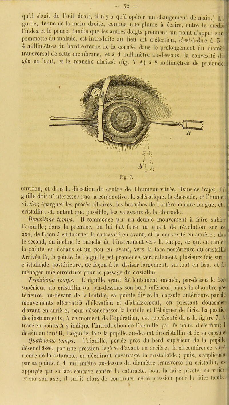 1 qu'il s'ugit de l'œil droit, il n'y a qu'à o]mv.v un diaiigement de main.) L' guilie, lenuc de la main droite, comme une plume à écrire, entre le médii l'index et le pouce, tandis que les autres doigts prennent un point d'appui sui pommette du malade, est introduite au lieu dit d'élection, c'est-à-dire à 3 4 millinictres du bord externe de la cornée, dans le piolongement du diamè transversal de cette membrane, et à 1 millimètre au-dessous, la convexité ili gée en liant, et le manche abaissé (fig. 7 A) à « millimètres de profonde environ, et dans la direction du centre de l'humeur vitrée. Dans ce trajet, l'i'i guilie doit n'intéresser que la conjonctive, la sclérotique, la clioroïde, et l'huraec vitrée; épargner les procès ciliaires, les branches de l'artère ciliairc longue, et. cristallin, et, autant que possible, les vaisseaux de la choroïde. ■ Deuxième temps. Il commence par un double mouvement à faire subirr l'aiguille; dans le premiei-, on lui fait faire un quart de révolution sur se axe, de façon à en tourner la concavité en avant, et la convexité en arrière; dan le second, on incUne le manche de l'inslrument vers la tempe, ce qui en ramèç la pointe en dedans et un peu en avant, vers la face postérieure du cristalfl| Arrivée là, la pointe de l'aiguille est promenée verlicalement plusieurs fois suiH cristalloïde postérieure, de façon à la diviser largement, surtout en bas, et îm ménager une ouverture pour le passage du cristallin. Troisième temps. L'aiguille ayant été lentement amenée, par-dessus le bor i supérieur du cristallin ou par-dessous son bord inférieur, dans la chambre po; lérieure, au-devant de la lentille, sa pointe divise la capsule antérieure par di mouvements alternatifs d'élévation et d'abaissement, en pressant douccinei d'avant en arrière, pour déscnchàsser la lentdic et l'éloigner de l'iris. La posilio des instruments, à ce moment de l'opération, est représenté dans la figure 7. l tracé en points A y indique l'introduction de l'aiguille par le ])oint d'élection; I dessin au trait 13, l'aiguille dans la pupille au-devant ducristallin et de sa capsule Quatrième temps. L'aiguille, portée près du bord supérieur de la pupille désencliàsse, par une pression légère d'avant en arrière, la circonférence supé rieure de la cataracte, en déchirant davantage la cristalloïde ; puis, s'nppliiiuaii par sa pointe à i millimètre au-dessus du diamètre Iransvcrsc du cristallin, es appuyée par sa l'ace concave contre la cataracte, pour la faire pivoter on arrière et sur son axe; il suflit alors de continuer celle pression poiu-la l'aire tombe i I