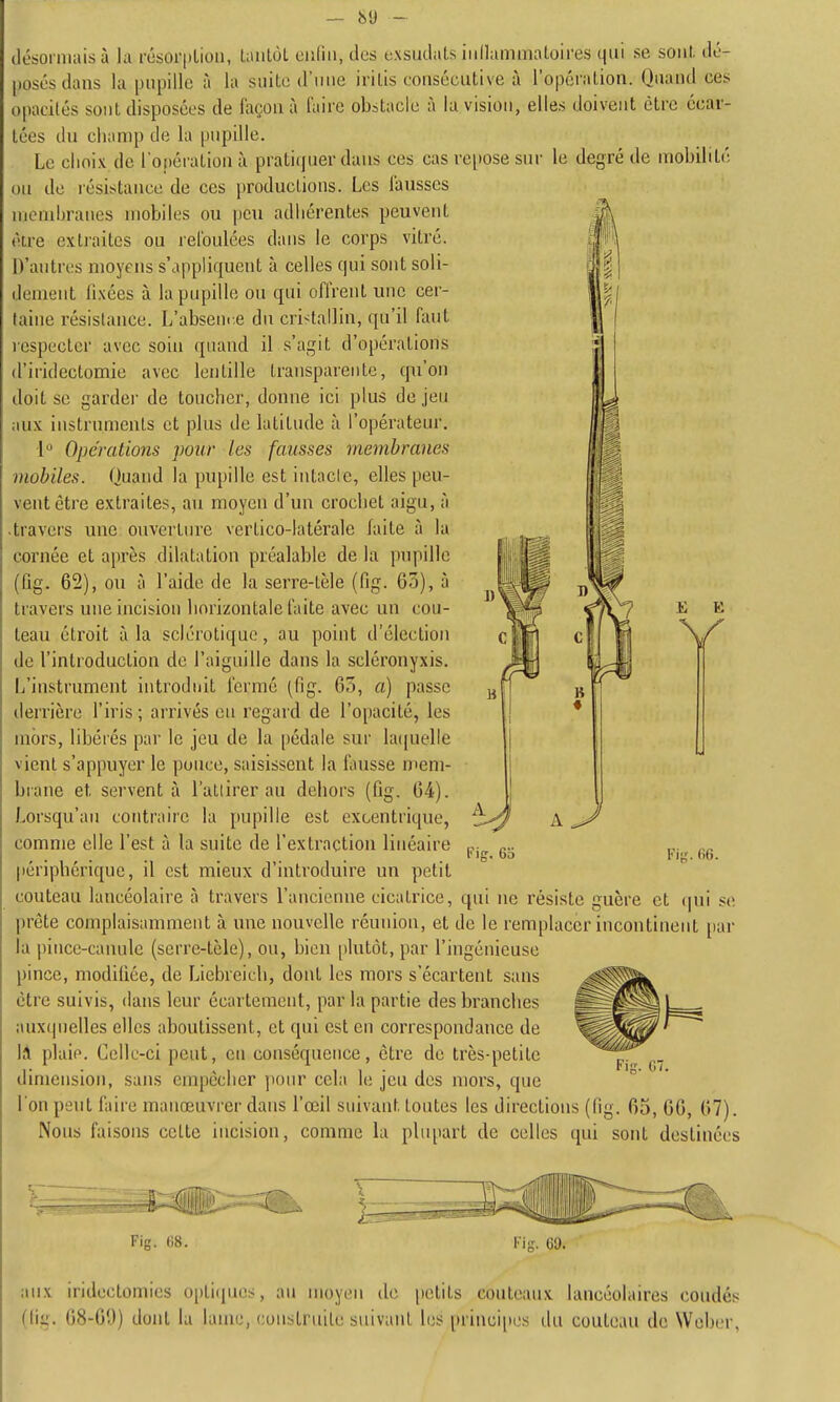 ilésorniais à la rôsorpliou, LaiiLoL ciiliii, des exsudais iiillammaloires qui se sont, dé- posés dans la pupille à la suite d'une iritis consécutive à l'opération. Quand ces opacités sont disposées de façon à faire obstacle à la vision, elles doivent être écar- tées du champ de la pupille. Le choix de l'opération à praticpier dans ces cas re[tose sur le degré de mobilité ou de résistance de ces j)roducUons. Les fausses membranes mobiles ou peu adhérentes peuvent être extraites ou refoulées dans le coi'ps viti'é. D'autres moyens s'appliquent à celles qui sont soli- dement fixées à la pupille ou qui offrent une cer- taine résistance. L'absem-.e du cristallin, qu'il faut respecter avec soin quand il s'agit d'opérations d'iridectomie avec lentille transparente, qu'on doit se garder de toucher, donne ici plus de jeu aux instruments et plus de latitude à l'opérateur. 1'^ Opérations pour les fausses membranes mobiles. Quand la pupille est intacte, elles peu- vent être extraites, au moyen d'un crochet aigu, à • travers une ouverture vertico-latérale faite à la cornée et après dilatation préalable de la pupille (Gg. 62), ou à l'aide de la serre-tèle (fig. 63), à travers une incision horizontale faite avec un cou- teau étroit à la sclérotique, au point d'élection de l'introduction de l'aiguille dans la scléronyxis. L'instrument introduit fermé (fig. 63, a) passe derrière l'iris ; arrivés en regard de l'opacité, les mors, libérés par le jeu de la pédale sur huiuelle vient s'appuyer le ponce, saisissent la iiiusse mem- brane et servent à l'attirer au dehors (fig. 64). Lorsqu'au contraire la pupille est excentrique, comme elle l'est à la suite de l'extraction linéaire périphérique, il est mieux d'introduire un petit couteau lancéolaire à travers l'ancienne cicatrice, qui ne résiste guère et (|ui se prête complaisaniment à une nouvelle réunion, et de le remplacer incontinent par la pince-canule (serre-tèle), ou, bien [)lutàt, par l'ingénieuse pince, modifiée, de Liebreicli, dont les mors s'écartent sans être suivis, dans leur écartement, par la partie des branches aux(]uelles elles aboutissent, et qui est en correspondance de Id plaie. Celle-ci peut, en conséquence, être de très-petite dimension, sans enqièclier ponr cela le jeu des mors, que l'on peut faire manœuvrer dans l'œil suivant toutes les directions (fig. 65, 66, 67). Nous faisons cette incision, comme la plupart de celles qui sont destinées E E V Fig. 6b Fifî. 66. Fig. 07. 3 Fig. 68. Fig. 69. aux iridectomics opti(iues, au moyen de petits couteaux lancéolaires coudés (fig. 68-69) dont la lame, construite suivant les priuci[ies du couteau de Wober,