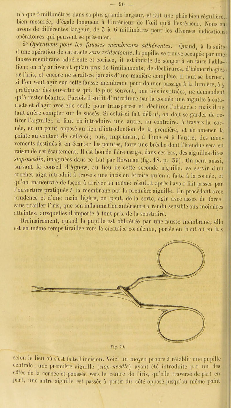 n'a que 3 millimètres dans sa plus grande largeur, et (ail une plaie bien régulière, bien mesurée, d'égale longueur à l'iiilérieur de l'œil qu'à l'exlérieur. Nous en avons de différentes largeur, de 3 ù 6 millimètres pour les diverses indications opératoires qui peuvent se présenter. 2° Opérations pour les fausses membranes adhérentes. Quand, à la suite d'une opération de cataracte sans irideclomie, la pupille se trouve occupée par une fausse membrane adhérente et coriace, il est inutile de songer à en faire l'abla- tion; on n'y arriverait qu'au prix de tiraillements, de déchirures, d'hémorrhagies de l'iris, et encore ne serait-ce jamais d'une manière complète, il faut se borner, si l'on veut agir sur cette fausse membrane pour donner passage à la lumière, à y pratiquer des ouvertures qui, le plus souvent, une fois instituées, ne demandent qu'à rester béantes. Parfois il suffit d'introduire par la cornée une aiguille à cata- l'acte et d'agir avec elle seule pour transpercer et déchirer l'ohstade : mais il ne faut guère compter sur le succès. Si celui-ci fait défaut, on doit se garder de re- tirer l'aiguille; il faut en introduire une autre, au contraire, à travers la cor- née, en un point opposé au lieu d'introduction de la première, et en amener la pointeau contact de celle-ci; puis, imprimant, à l'une et à l'autre, des mou- vements destinés à en écarter les pointes, faire une brèche dont l'étendue sera en raison de cet écartement. Il est bon de faire usage, dans ces cas, des aiguilles dites stop-needle, imaginées dans ce but par Bovvman (fig. 18, p. 39). On peut aussi, suivant le conseil d'Agnevv, au lieu de cette seconde aiguille, se servir d'un crochet aigu introduit à travers une incision étroite qu'on a faite à la cornée, et ipi'on manœuvre de façon à arriver au même résultat après l'avoir fait passer par l'ouverture pratiquée à la membrane par la première aiguille. En procédant avec prudence et d'une main légère, on peut, de la sorte, agir avec assez de force sans tirailler l'iris, que son inflammation antérieure a rendu sensible aux moindres atteintes, auxquelles il importe à tout prix de la soustraire. Ordinairement, quand la pupille est oblitérée par une fausse membrane, elle est en même temps tiraillée vers la cicatrice cornéenne, portée en haut ou en bas Fig. 70. selon le lieu où s'est l'aile l'incision. Voici un moyen pro|)re à rétablir une pupille centrale: une première aiguille {stop-needle) ayant été introduite p;ir un des cotes de la cornée et poussée vers le centre de l'iris, (pi'elle traverse tle part en part, une autre aiguille est passée à partir du côté opposé jus(|u'au nicme point