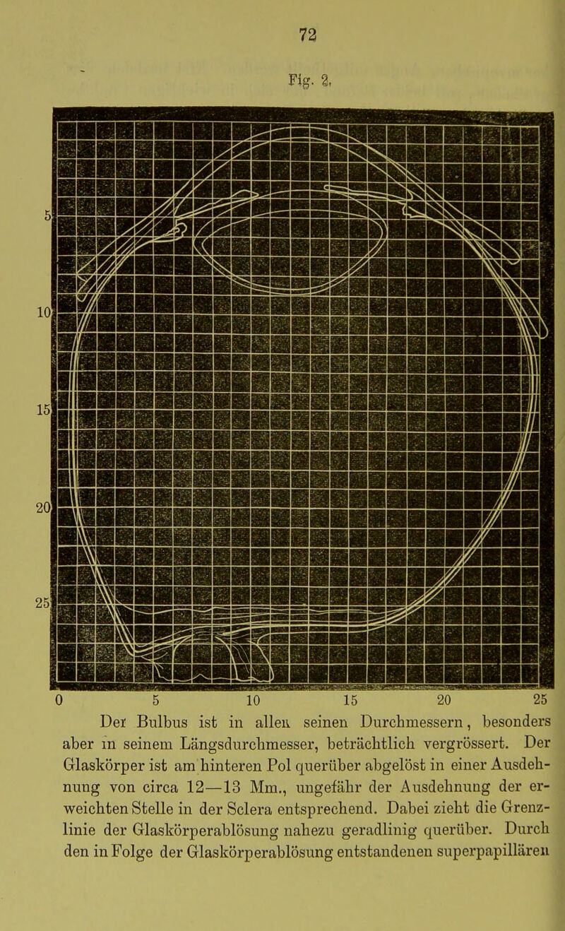 73 Fig. 2, 5 10 15 20 25 Der Bulbus ist in allen, seinen Durchmessern, besonders aber in seinem Längsdurclimesser, beträchtlich vergrössert. Der Glaskörper ist am hinteren Pol querüber abgelöst in einer Ausdeh- nung von circa 12—13 Mm., ungefähr der Ausdehnung der er- weichten Stelle in der Sclera entsprechend. Dabei zieht die Grenz- linie der Glaskörperablösung nahezu geradlinig querüber. Durch den in Folge der Glaskörperablösung entstandenen superpapilläreii