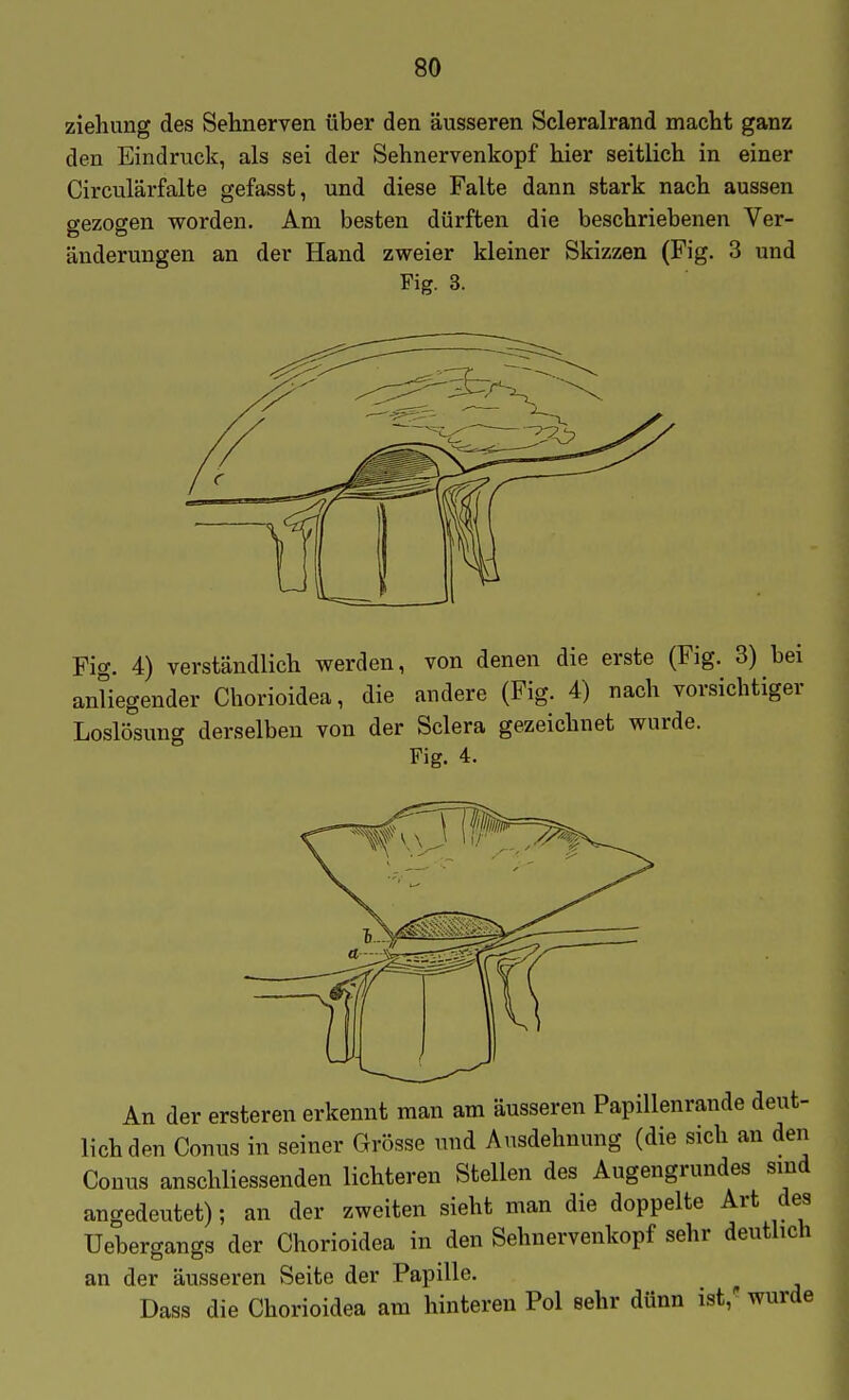 Ziehung des Sehnerven über den äusseren Scleralrand macht ganz den Eindruck, als sei der Sehnervenkopf hier seitlich in einer Circulärfalte gefasst, und diese Falte dann stark nach aussen gezogen worden. Am besten dürften die beschriebenen Ver- änderungen an der Hand zweier kleiner Skizzen (Fig. 3 und Fig. 3. Fig. 4) verständlich werden, von denen die erste (Fig. 3) bei antiesender Chorioidea, die andere (Fig. 4) nach vorsichtiger derselben von der Sclera gezeichnet wurde. Fig. 4. Loslösung An der ersteren erkennt man am äusseren Papillenrande deut- lich den Conus in seiner Grösse und Ausdehnung (die sich an den Conus anschliessenden lichteren Stellen des Augengrundes sind angedeutet); an der zweiten sieht man die doppelte Art des Uebergangs der Chorioidea in den Sehnervenkopf sehr deutlich an der äusseren Seite der Papille. ^ Dass die Chorioidea am hintereu Pol sehr dünn ist, wurde