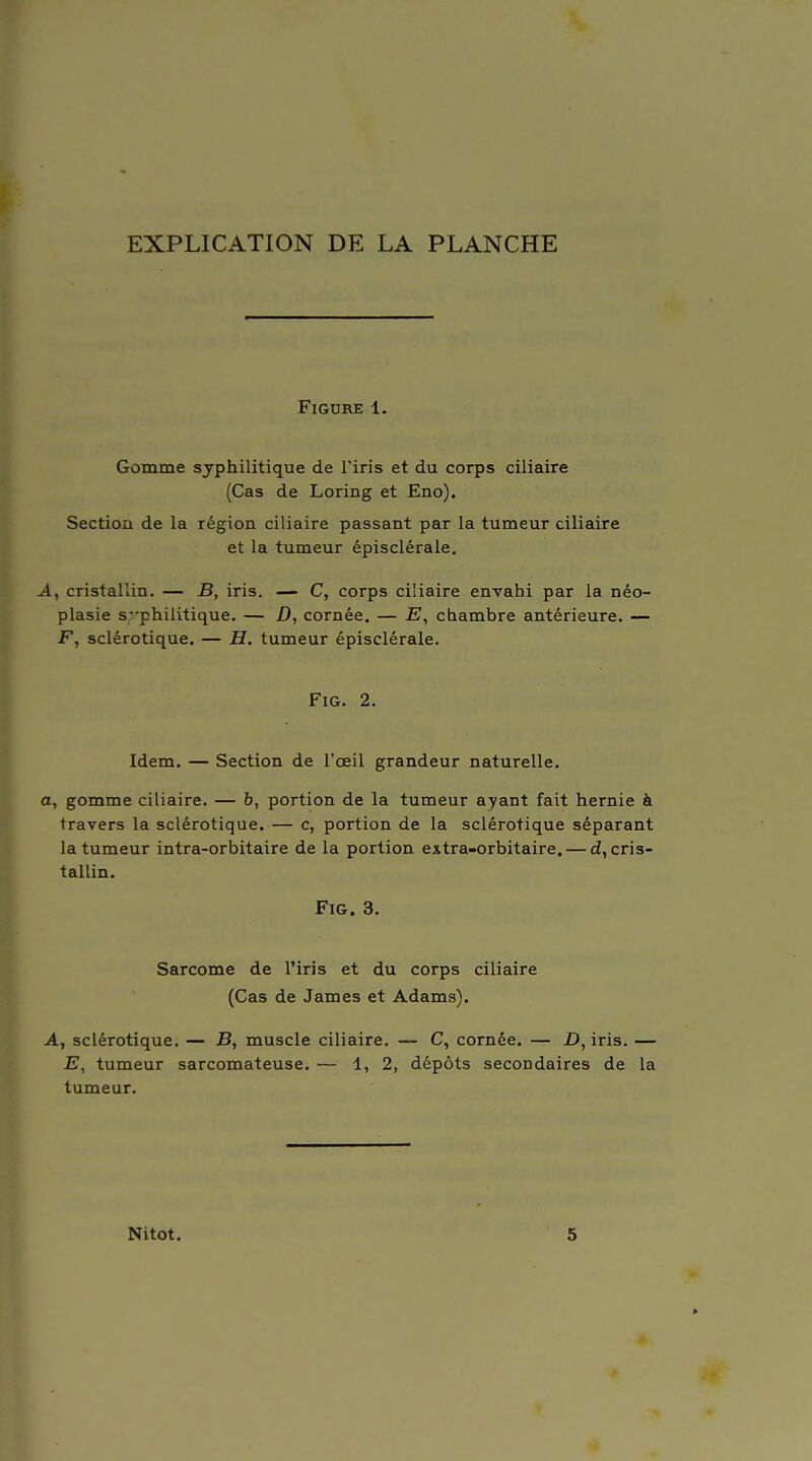 EXPLICATION DE LA PLANCHE Figure 1. Gomme syphilitique de l'iris et du corps ciliaire (Cas de Loring et Eno). Section de la région ciliaire passant par la tumeur ciliaire et la tumeur épisclérale. A, cristallin. — B, iris. — C, corps ciliaire envahi par la néo- plasie s-'philitique. — D, cornée. — E, chambre antérieure. — F, sclérotique. — H. tumeur épisclérale. FiG. 2. Idem. — Section de l'oeil grandeur naturelle. a, gomme ciliaire. — b, portion de la tumeur ayant fait hernie à travers la sclérotique. — c, portion de la sclérotique séparant la tumeur intra-orbitaire de la portion extra-orbitaire. — d, cris- tallin. FiG. 3. Sarcome de l'iris et du corps ciliaire (Cas de James et Adams). A, sclérotique. — B, muscle ciliaire. — C, cornée. — £), iris. — E, tumeur sarcomateuse. — 1, 2, dépôts secondaires de la tumeur. Nitot. 5