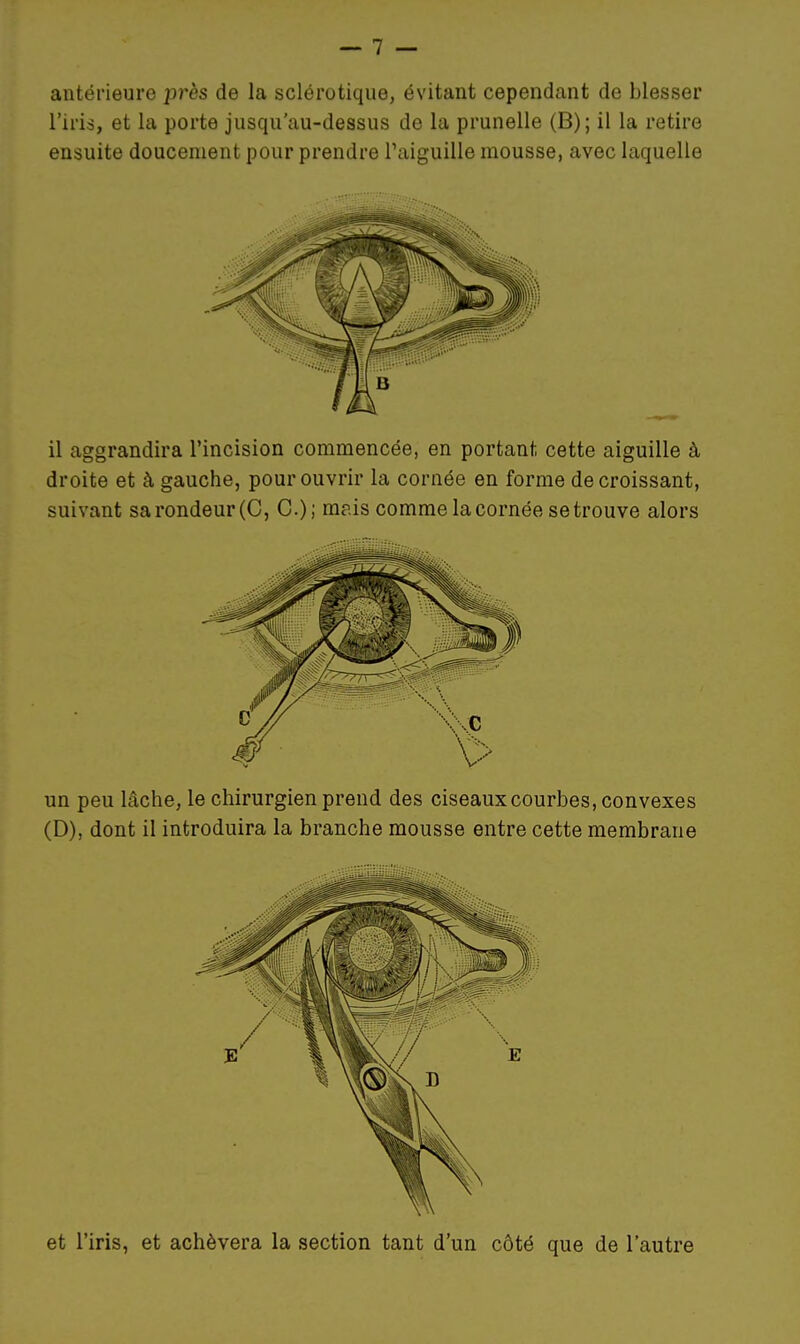 antérieure près de la sclérotique, évitant cependant de blesser l'iris, et la porte jusqu'au-dessus de la prunelle (B); il la retire ensuite doucement pour prendre Paiguille mousse, avec laquelle il aggrandira l'incision commencée, en portant cette aiguille à droite et à gauche, pour ouvrir la cornée en forme décroissant, suivant sa rondeur (C, C); mais comme la cornée se trouve alors un peu lâche, le chirurgien prend des ciseaux courbes, convexes (D), dont il introduira la branche mousse entre cette membrane et l'iris, et achèvera la section tant d'un côté que de l'autre