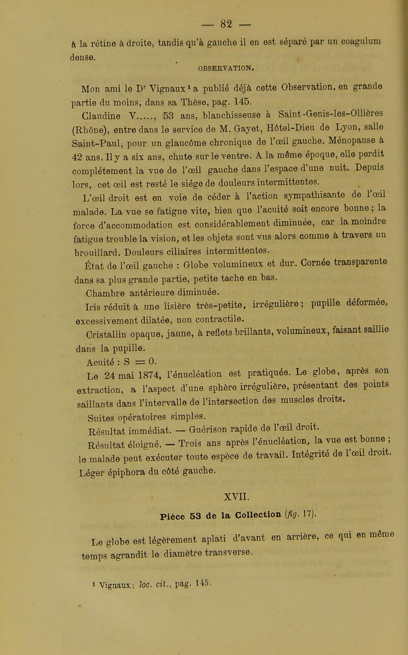 à la rétine à droite, tandis qu'à gauche il en est séparé par un coagulum dense. OBSERVATION. Mon ami le Dr Vignaux'a publié déjà cette Observation, en grande partie du moins, dans sa Thèse, pag. 145. Claudine V , 53 ans, blanchisseuse à Saint -Genis-les-Ollières (Rhône), entre dans le service de M. Gayet, Hôtel-Dieu de Lyon, salle Saint-Paul, pour un glaucôme chronique de l'œil gauche. Ménopause à 42 ans. Il y a six ans, chute sur le ventre. A la môme époque, elle perdit complètement la vue de l'œil gauche dans l'espace d'une nuit. Depuis lors, cet œil est resté le siège de douleurs intermittentes. L'œil droit est en voie de céder à l'action sympathisante de l'œil malade. La vue se fatigue vite, bien que l'acuité soit encore bonne ; la force d'accommodation est considérablement diminuée, car la moindre fatigue trouble la vision, et les objets sont vus alors comme à travers un brouillard. Douleurs ciliaires intermittentes. État de l'œil gauche : Globe volumineux et dur. Cornée transparente dans sa plus grande partie, petite tache en bas. Chambre antérieure diminuée. Iris réduit à une lisière très-petite, irrégulière; pupille déformée, excessivement dilatée, non contractile. Cristallin opaque, jaune, à reflets brillants, volumineux, faisant saillie dans la pupille. Acuité : S = 0. Le 24 mai 1874, l'énucléation est pratiquée. Le globe, après son extraction, a l'aspect d'une sphère irrégulière, présentant des points saillants dans l'intervalle de l'intersection des muscles droits. Suites opératoires simples. Résultat immédiat. — Guérison rapide de l'œil droit. Résultat éloigné. - Trois ans après l'énucléation, la vue est bonne ; le malade peut exécuter toute espèce de travail. Intégrité de l'œil droit. Léger épiphora du côté gauche. XVII. Pièce 53 de la Collection (fig. 17). Le globe est légèrement aplati d'avant en arrière, ce qui en même temps agrandit le diamètre transverse. i Vignaux; loc. cit., pag. 145.