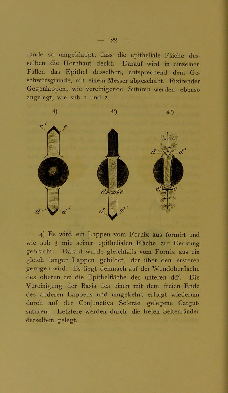 rande so umgeklappt, dass die epitheliale Fläche des- selben die Hornhaut deckt. Darauf wird in einzelnen Fällen das Epithel desselben, entsprechend dem Ge- schwürsgrunde, mit einem Messer abgeschabt. Fixirender Gegenlappen, wie vereinigende Suturen werden ebenso angelegt, wie sub i und 2. 4) 4') 4») 4) Es wird ein Lappen vom Fornix aus formirt und wie sub 3 mit seiner epithelialen Fläche zur Deckung gebracht. Darauf wurde gleichfalls vom Fornix aus ein gleich langer Lappen gebildet, der über den ersteren gezogen wird. Es liegt demnach auf der Wundoberfläche des oberen cc' die Epithelfläche des unteren dd'. Die Vereinigung der Basis des einen mit dem freien Ende des anderen Lappens und umgekehrt erfolgt wiederum durch auf der Conjunctiva Sclerae gelegene Catgut- suturen. Letztere werden durch die freien Seitenränder derselben gelegt.