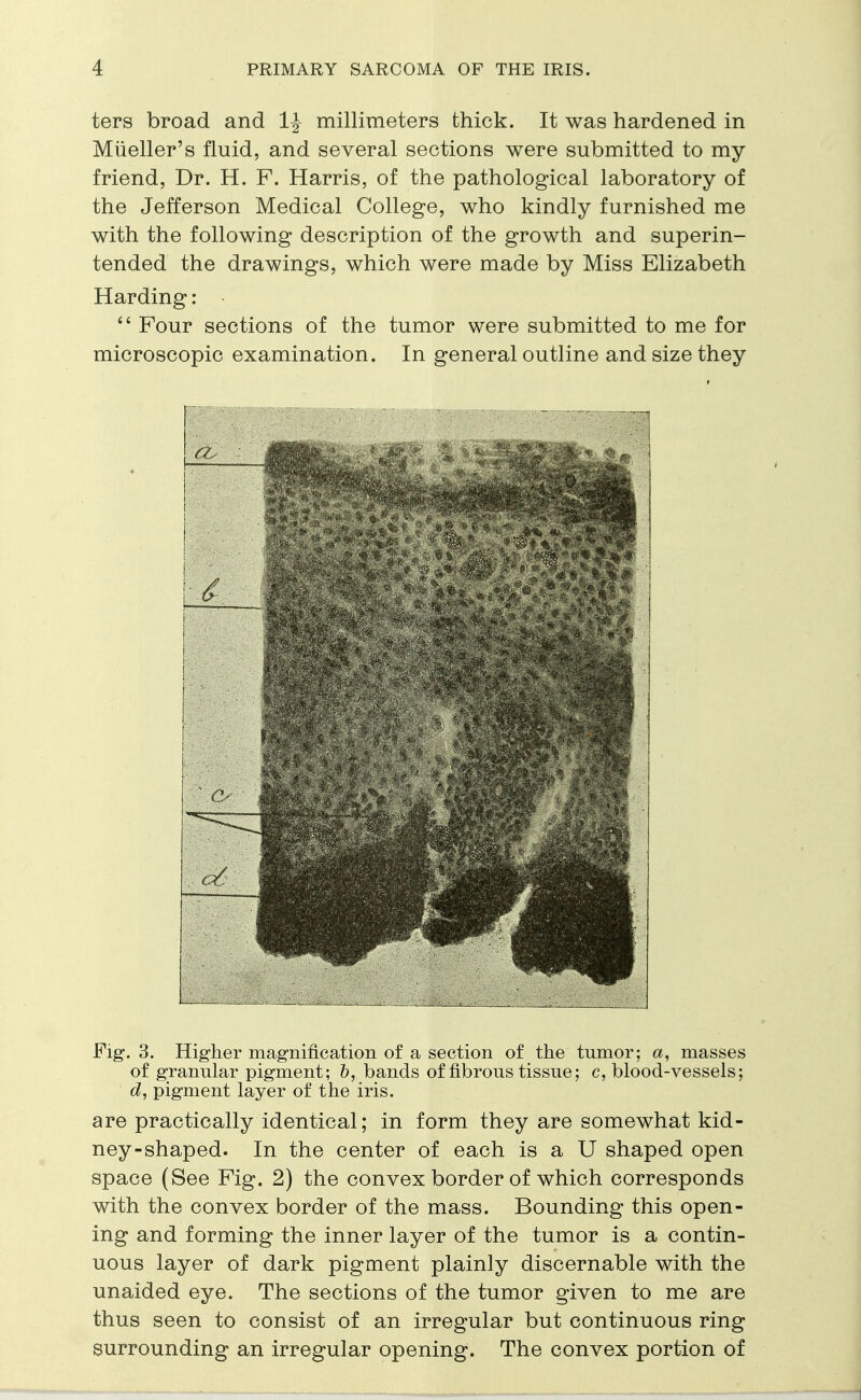 ters broad and 1| millimeters thick. It was hardened in Mueller's fluid, and several sections were submitted to my friend, Dr. H. F. Harris, of the pathological laboratory of the Jefferson Medical College, who kindly furnished me with the following description of the growth and superin- tended the drawings, which were made by Miss Elizabeth Harding: •  Four sections of the tumor were submitted to me for microscopic examination. In general outline and size they Fig-. 3. Higher magnification of a section of the tumor; a, masses of granular pigment; b, bands of fibrous tissue; c, blood-vessels; d, pigment layer of the iris. are practically identical; in form they are somewhat kid- ney-shaped. In the center of each is a U shaped open space (See Fig. 2) the convex border of which corresponds with the convex border of the mass. Bounding this open- ing and forming the inner layer of the tumor is a contin- uous layer of dark pigment plainly discernable with the unaided eye. The sections of the tumor given to me are thus seen to consist of an irregular but continuous ring surrounding an irregular opening. The convex portion of