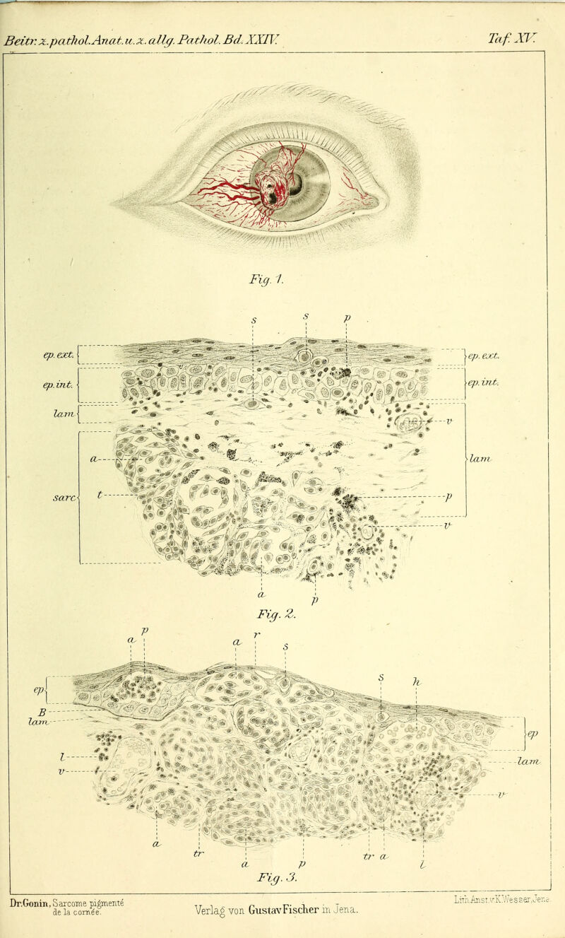 Taf.XK ep.ext. ep. int. lanv B larrv Fig. 1. \ep.ext. ep. int. lani Fig. Z. I f# v M la m Fig. 3. Dr.Gonin, Sarcome pigmenté de la cornée. Verlag von Gustav Fischer in Jena. Lirn.AnsrÂ'-K:A7esser,Jenc