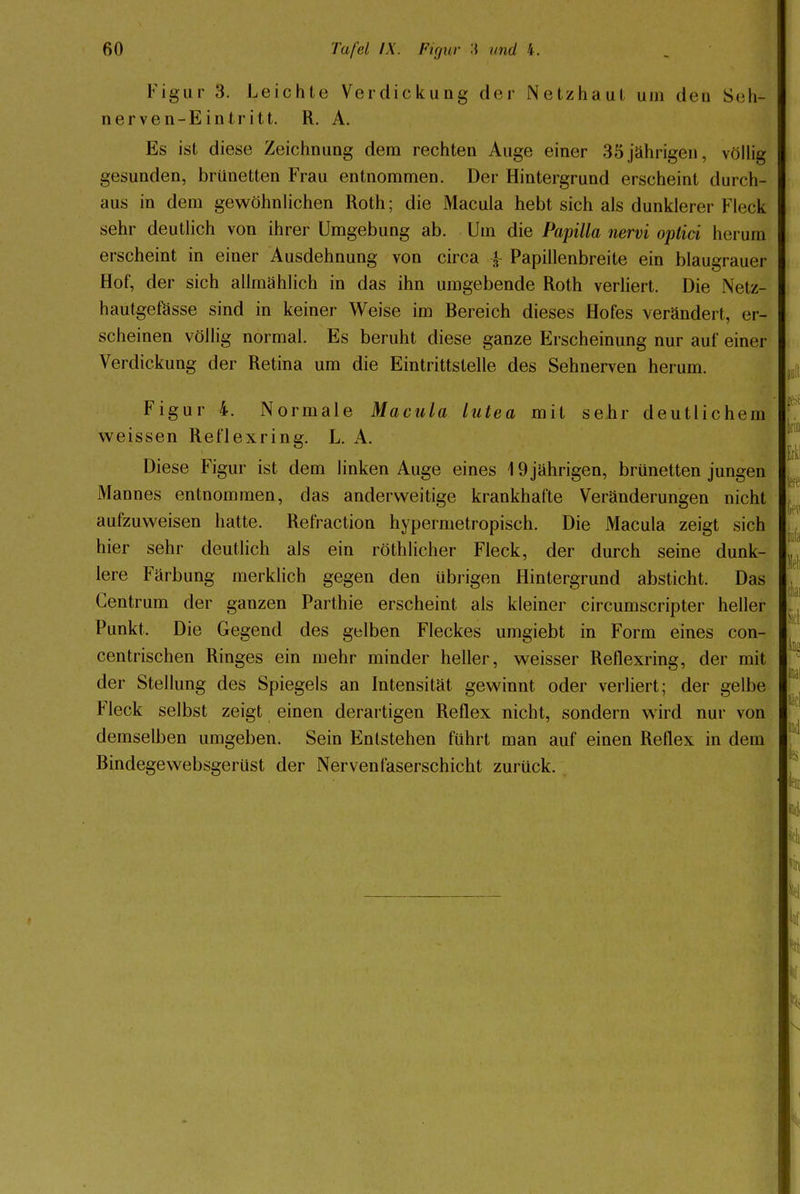 Figur 3. Leichte Verdickung der Netzhaut um den Seh- nerven-Eintritt. R. A. Es ist diese Zeichnung dem rechten Auge einer 35 jährigen, völlig gesunden, brünetten Frau entnommen. Der Hintergrund erscheint durch- aus in dem gewöhnlichen Roth; die Macula hebt sich als dunklerer Fleck sehr deutlich von ihrer Umgebung ab. Um die Papilla nervi optici herum erscheint in einer Ausdehnung von circa {- Papillenbreite ein blaugrauer Hof, der sich allmählich in das ihn umgebende Roth verliert. Die Netz- hautgefässe sind in keiner Weise im Bereich dieses Hofes verändert, er- scheinen völlig normal. Es beruht diese ganze Erscheinung nur auf einer Verdickung der Retina um die Eintrittstelle des Sehnerven herum. Figur 4. Normale Macula lutea mit sehr deutlichem weissen Reflexring. L. A. Diese Figur ist dem linken Auge eines 19 jährigen, brünetten jungen Mannes entnommen, das anderweitige krankhafte Veränderungen nicht aufzuweisen hatte. Refraction hypermetropisch. Die Macula zeigt sich hier sehr deutlich als ein röthlicher Fleck, der durch seine dunk- lere Färbung merklich gegen den übrigen Hintergrund absticht. Das Gentrum der ganzen Parthie erscheint als kleiner circumscripter heller Punkt. Die Gegend des gelben Fleckes umgiebt in Form eines con- centrischen Ringes ein mehr minder heller, weisser Reflexring, der mit der Stellung des Spiegels an Intensität gewinnt oder verliert; der gelbe Fleck selbst zeigt einen derartigen Reflex nicht, sondern wird nur von demselben umgeben. Sein Entstehen führt man auf einen Reflex in dem Bindegewebsgerüst der Nervenfaserschicht zurück.